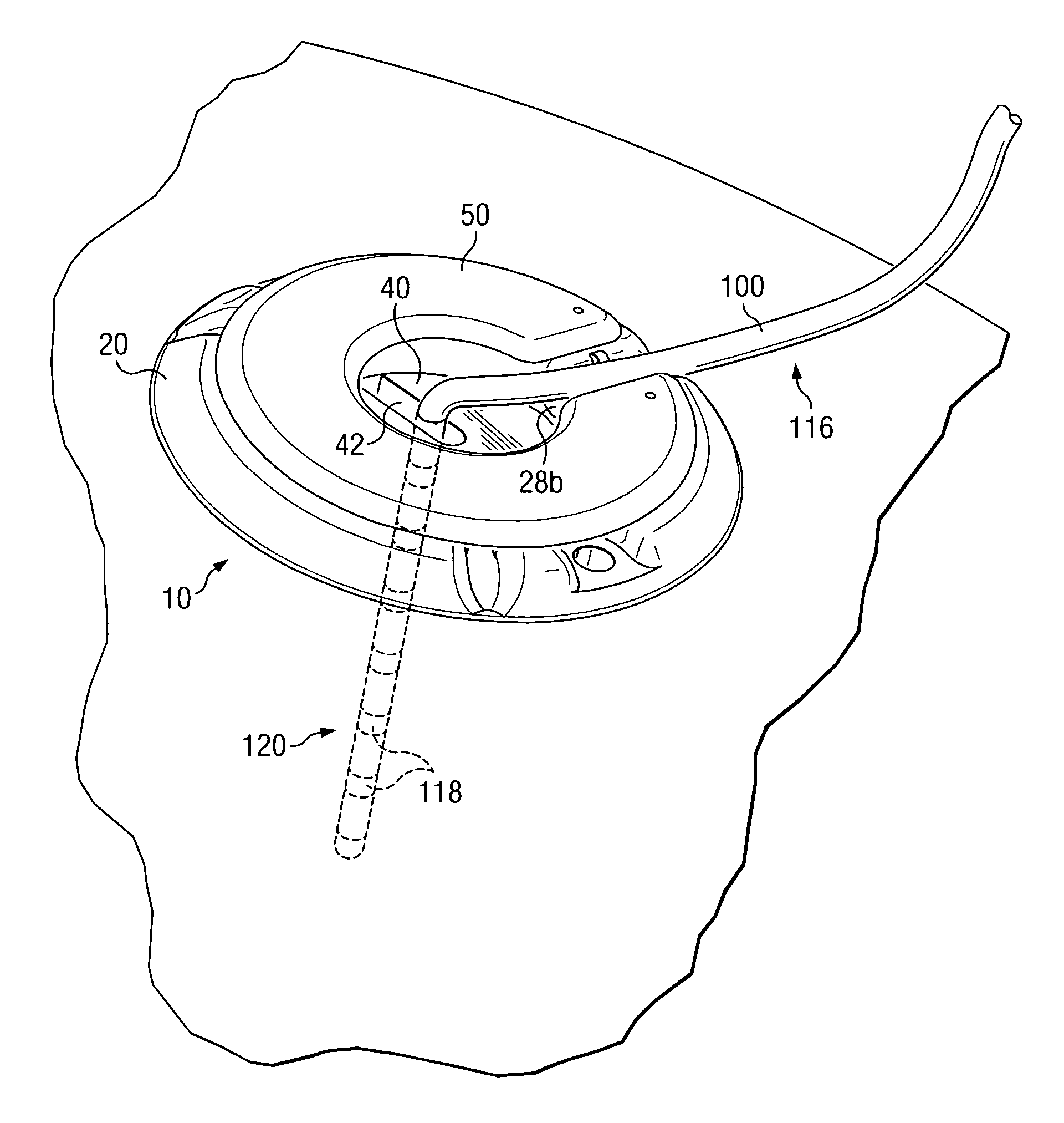 Electrical stimulation system and associated apparatus for securing an electrical stimulation lead in position in a person's brain