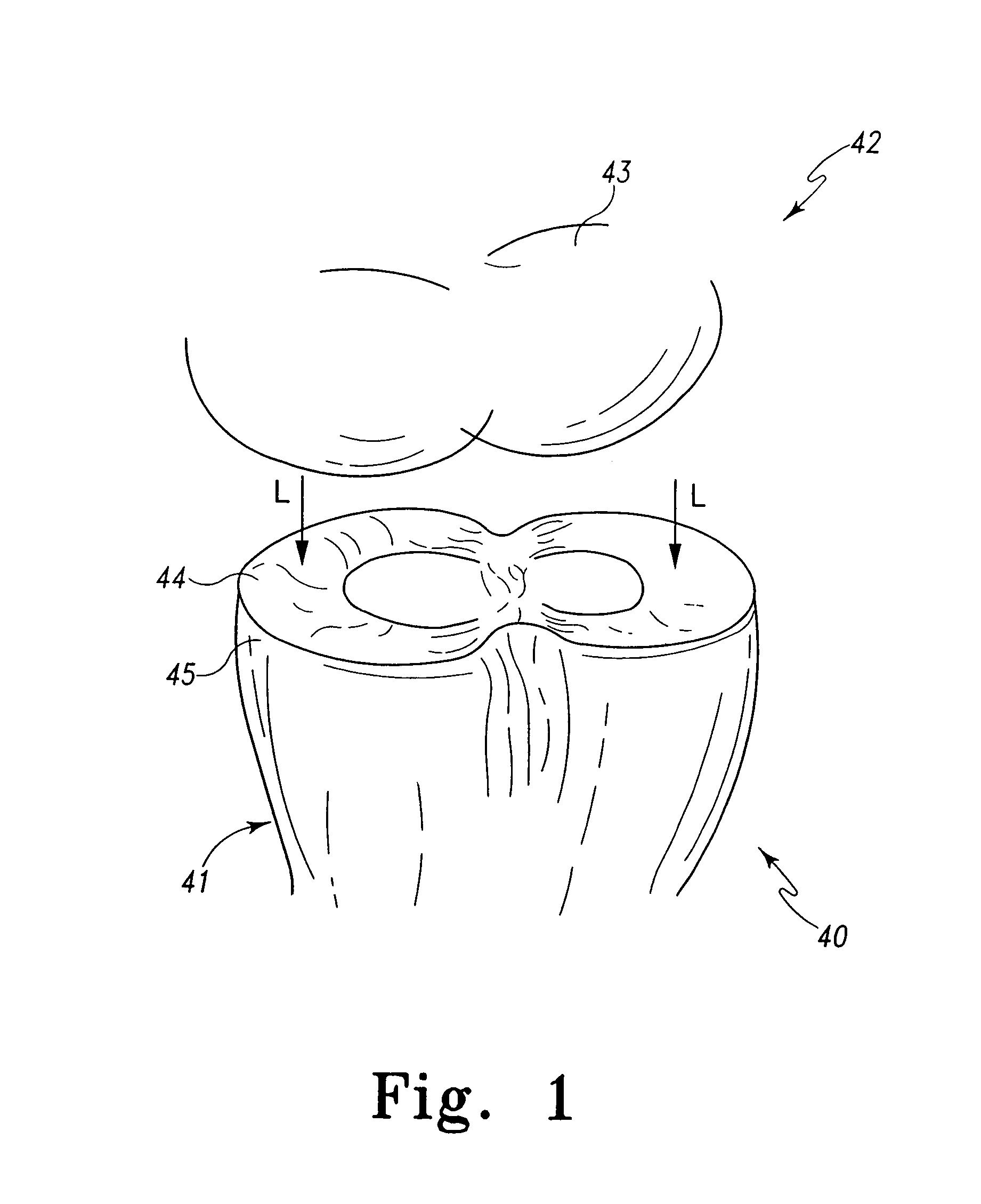 Implant device for cartilage regeneration in load bearing articulation regions