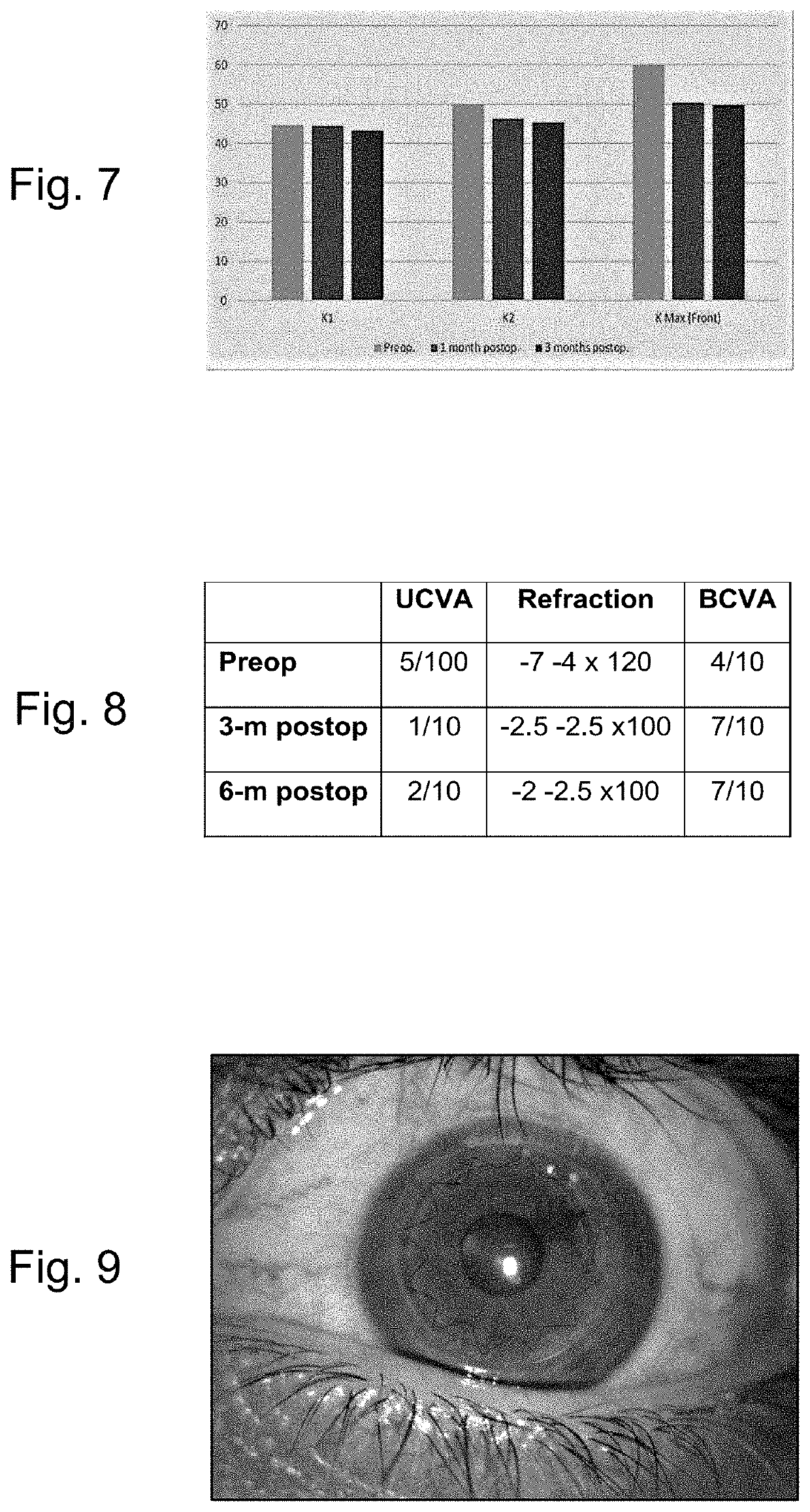 Intracorneal ring supported graft and method for cornea regeneration