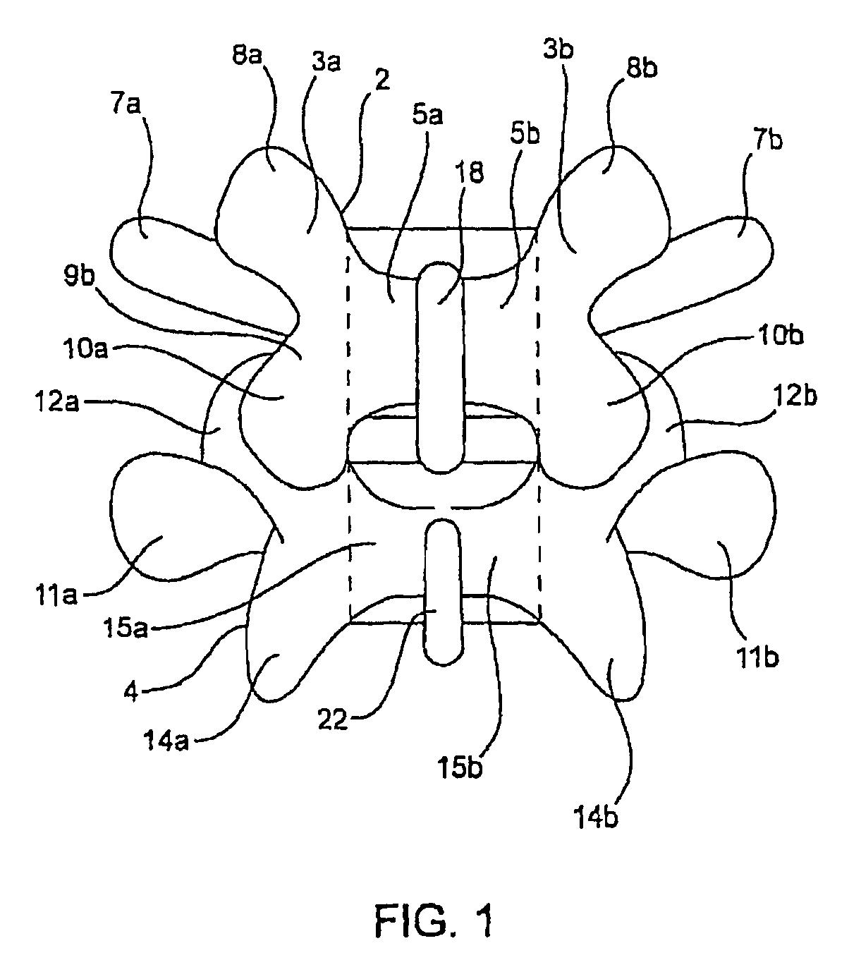 Systems and methods for posterior dynamic stabilization of the spine