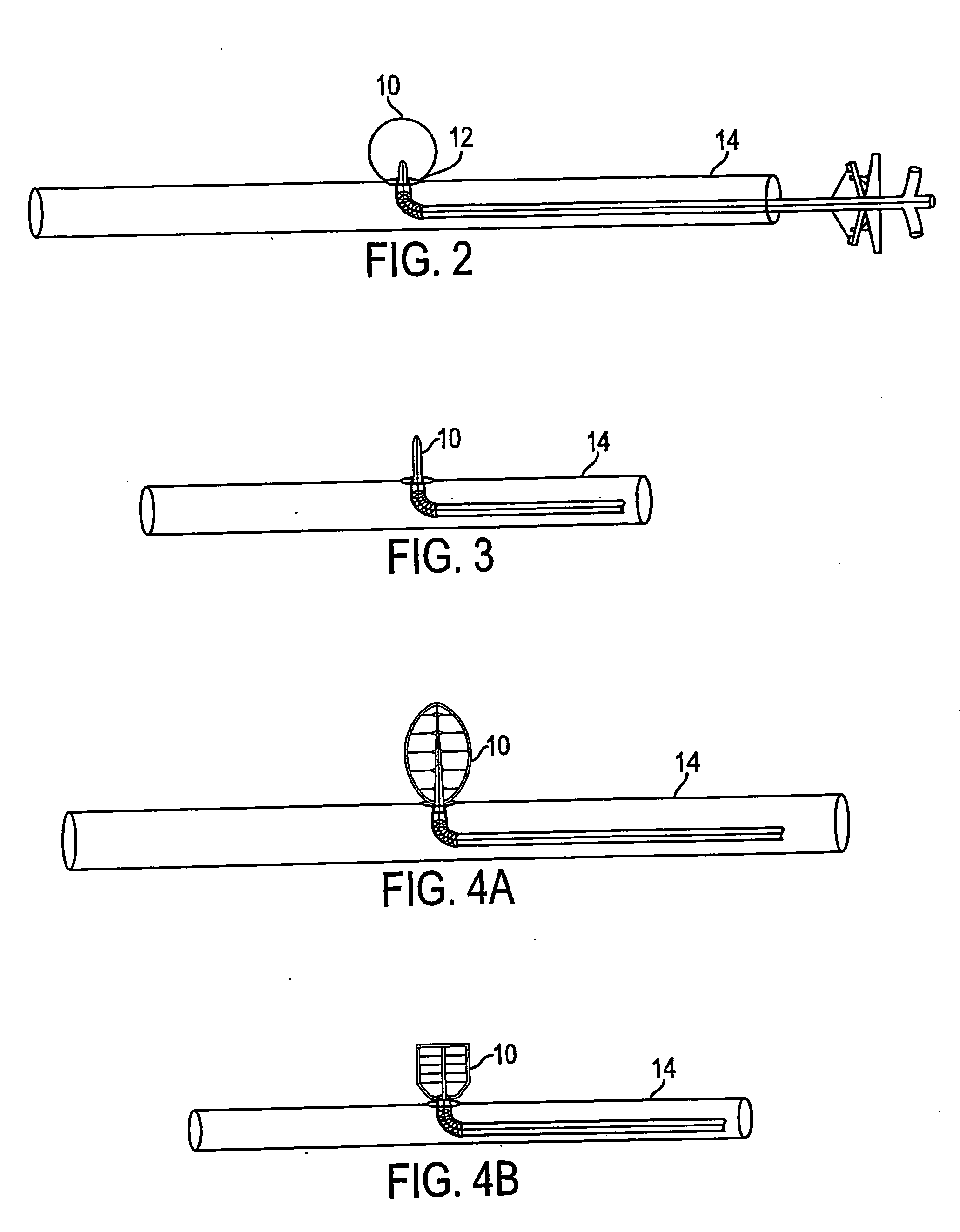 Endovascular aneurysm treatment device and method