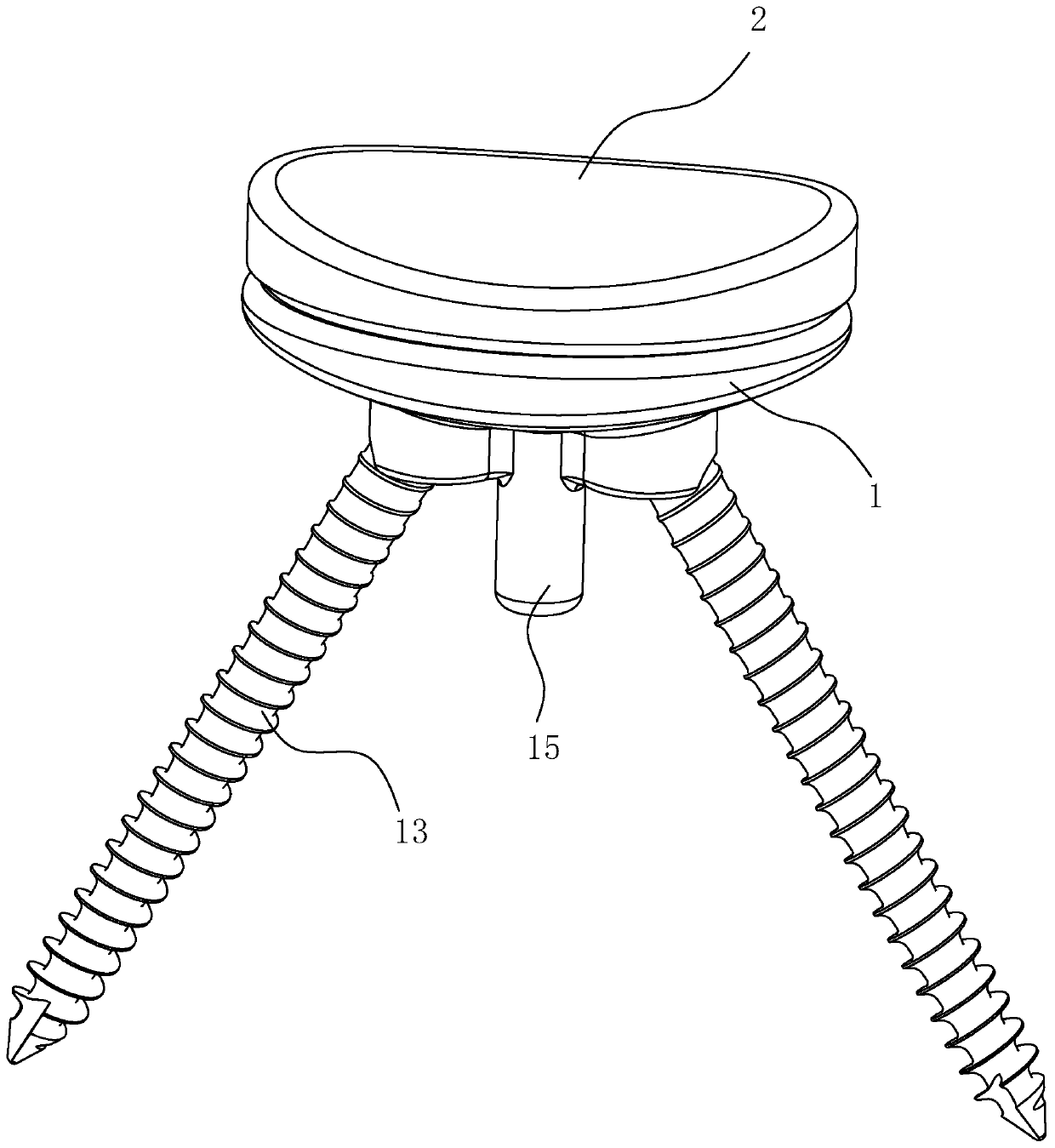 Glenoid prosthesis applied to total shoulder joint replacement