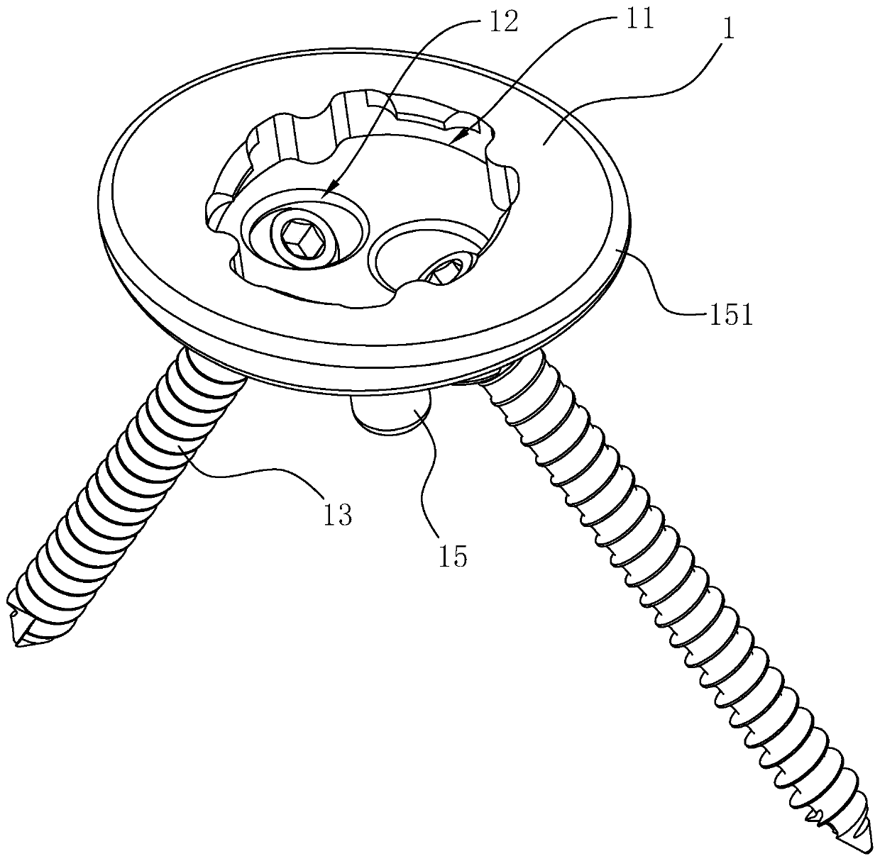 Glenoid prosthesis applied to total shoulder joint replacement