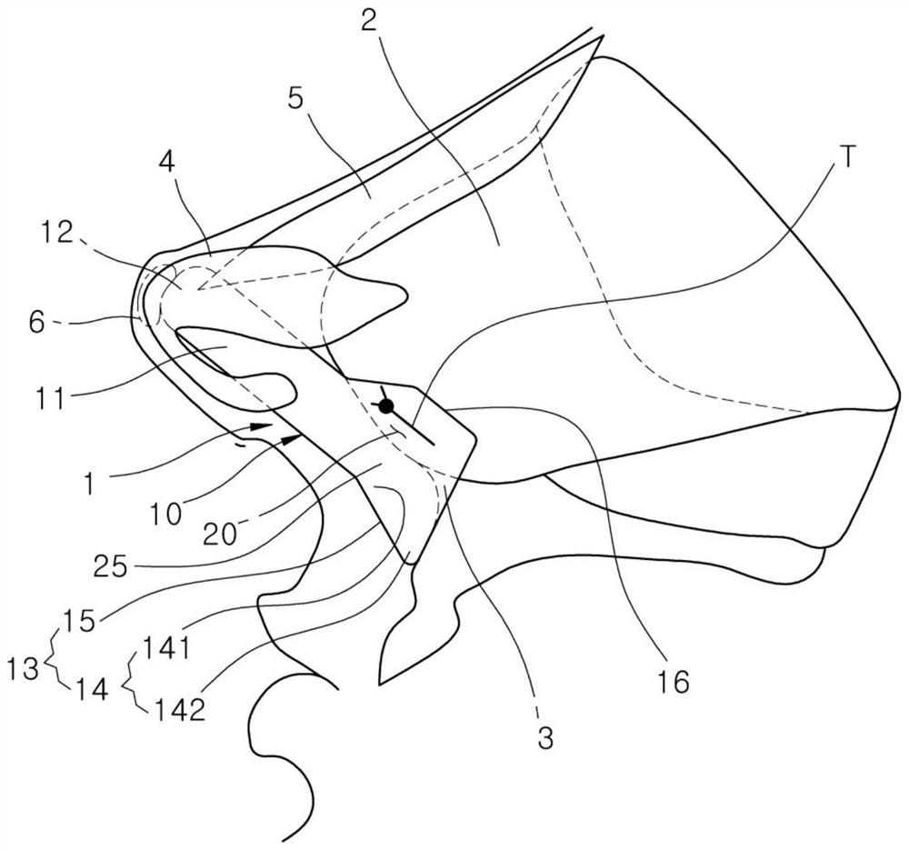 Nasal column prosthesis for rhinoplasty