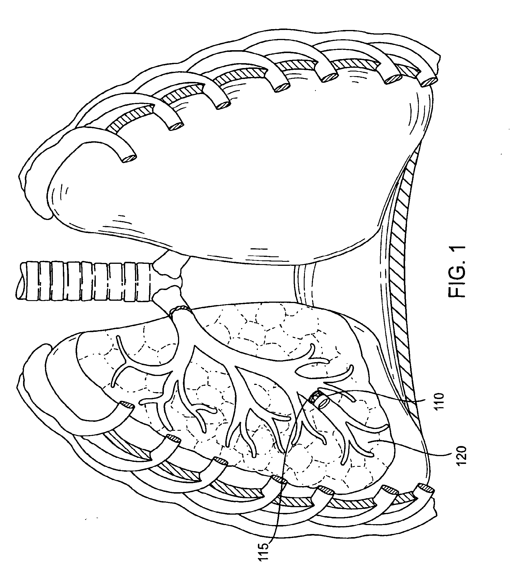 Bronchial flow control devices and methods of use