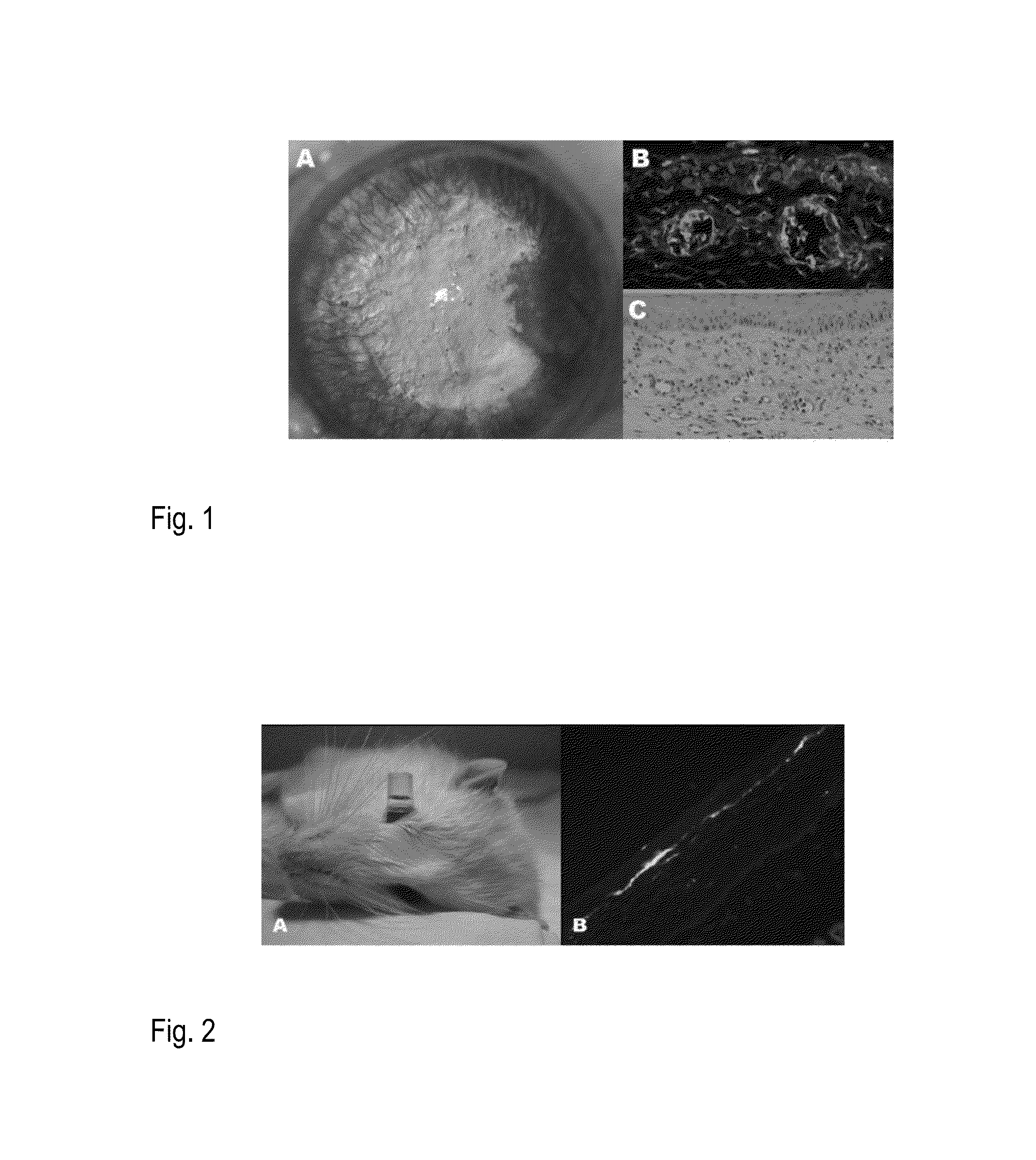 Protein Therapy for Treatment of Eye Diseases