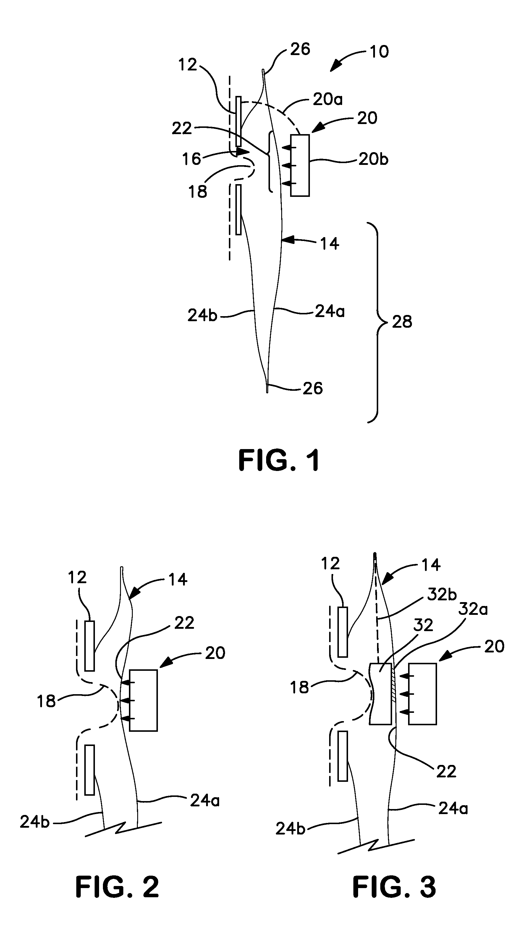 Controlled evacuation ostomy appliance