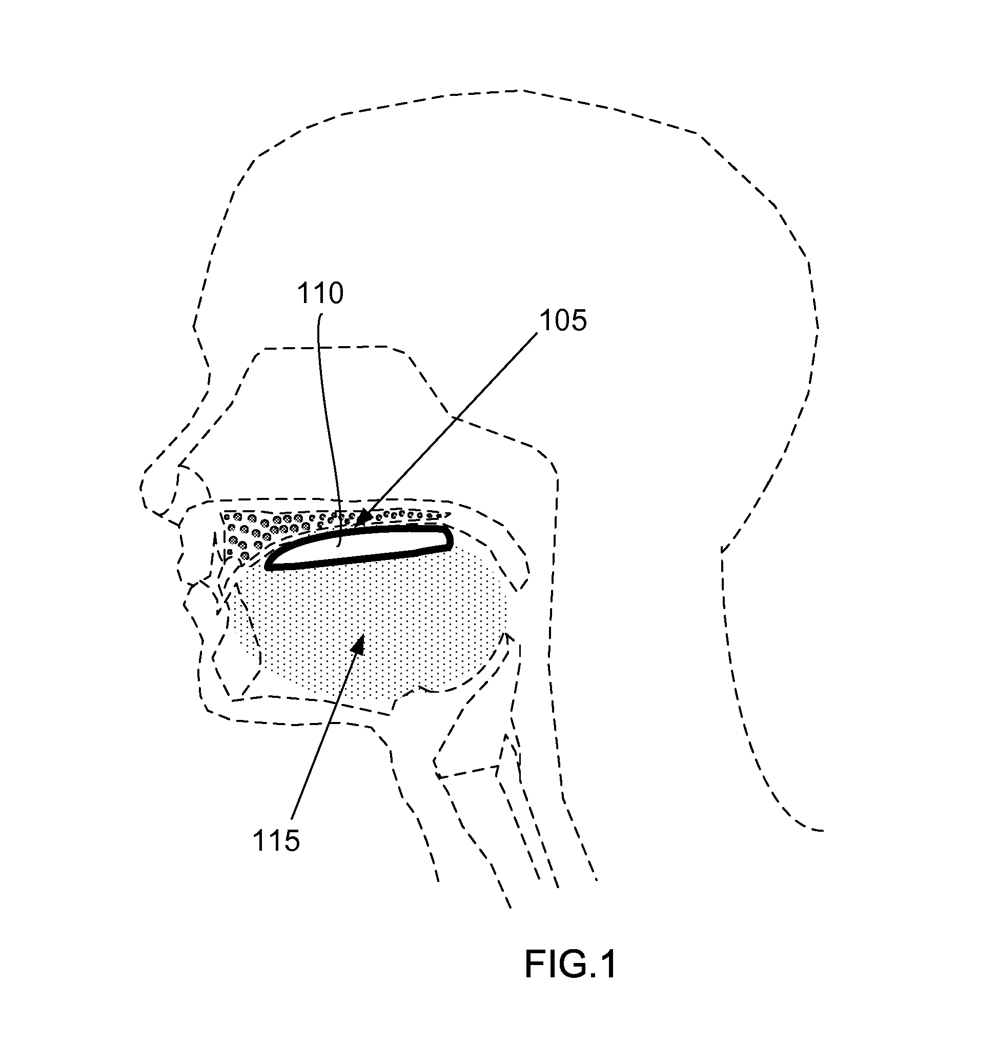 Intra-Oral Balance Device Based on Palatal Stimulation