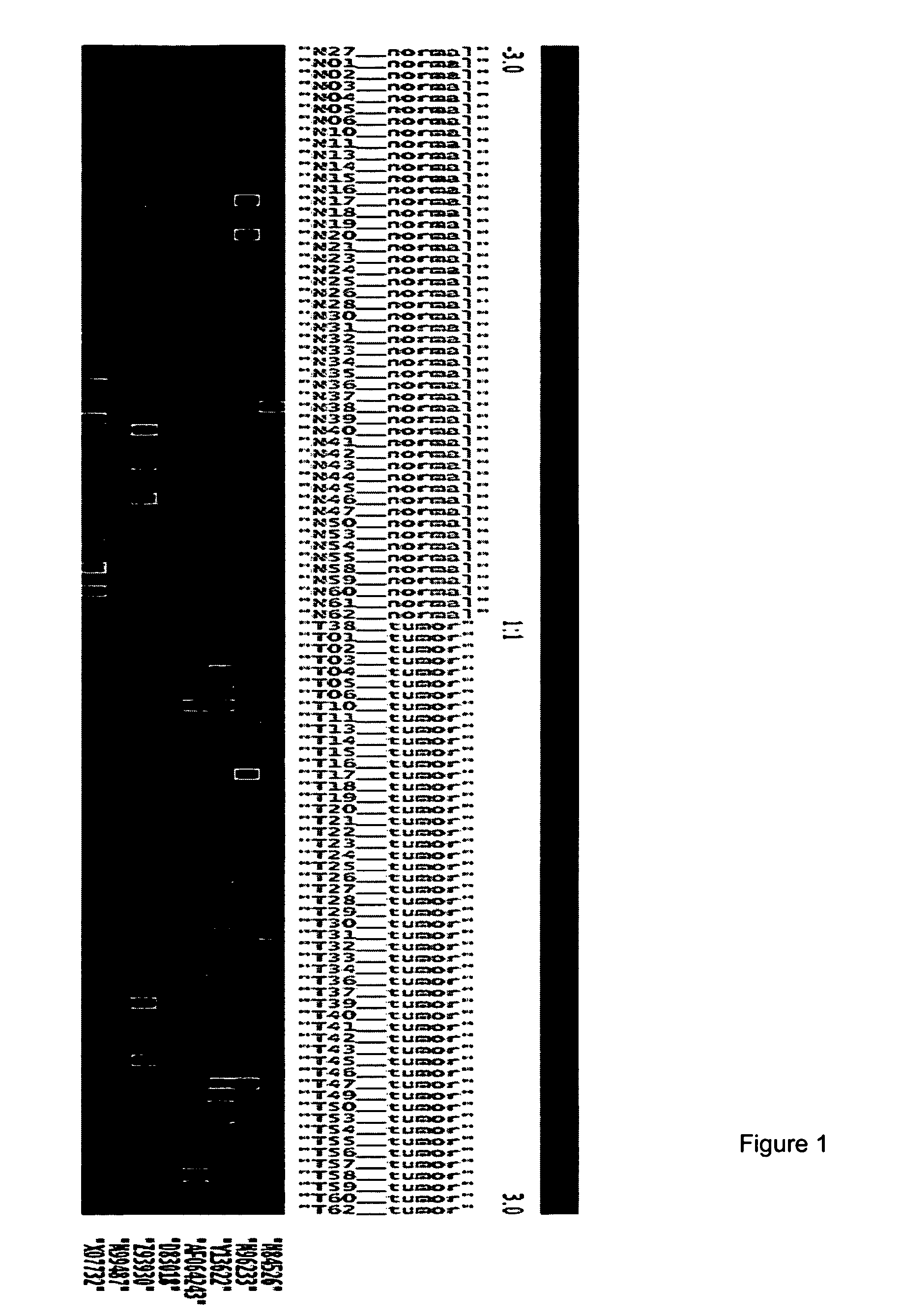 Molecular method for diagnosis of prostate cancer