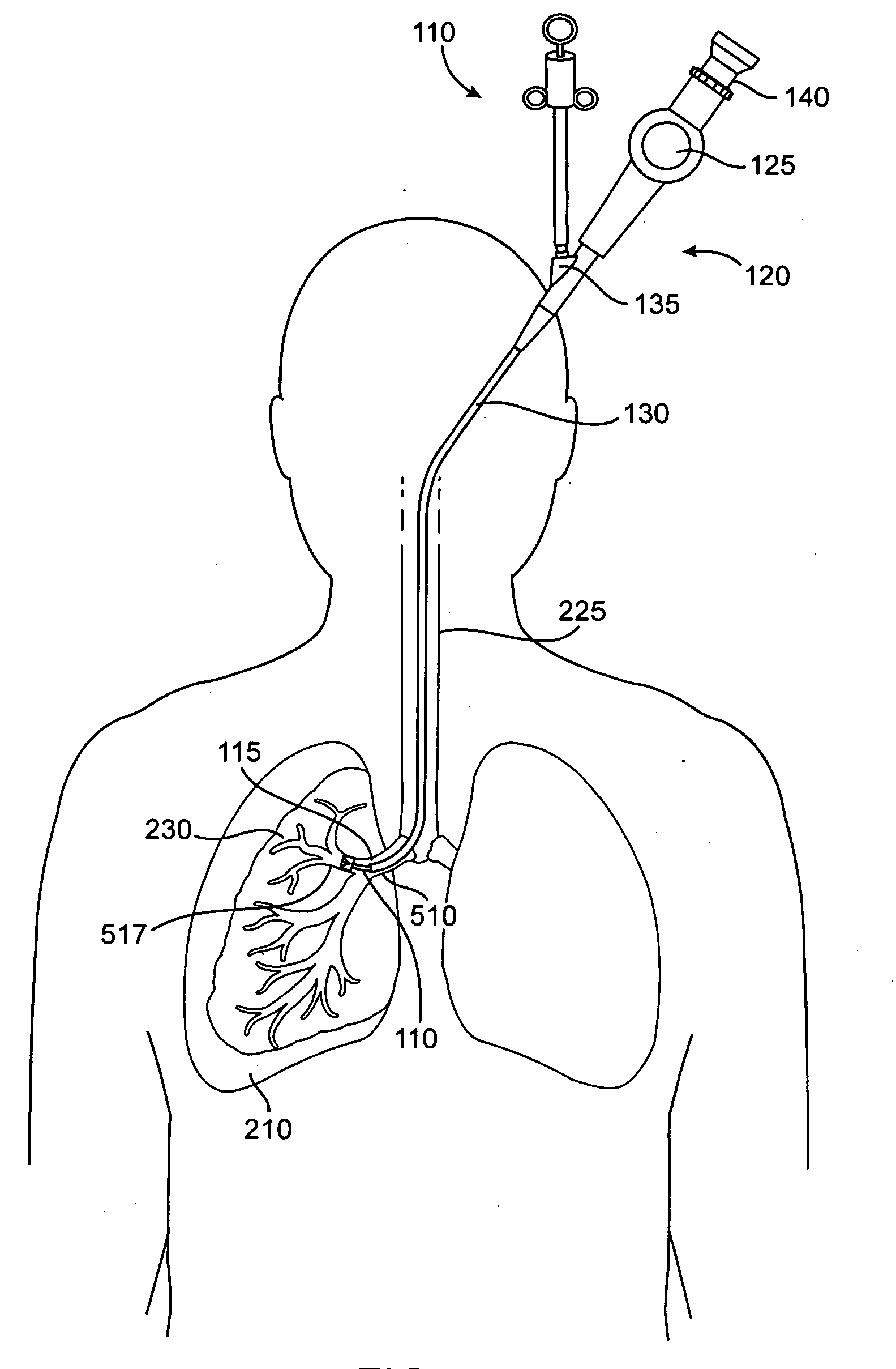 Delivery methods and devices for implantable bronchial isolation devices