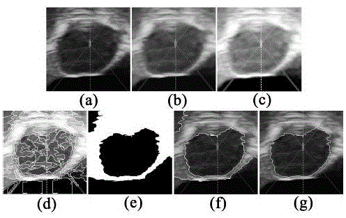 Construction Method of Similarity Matrix in ncut Segmentation of Ultrasonic Image