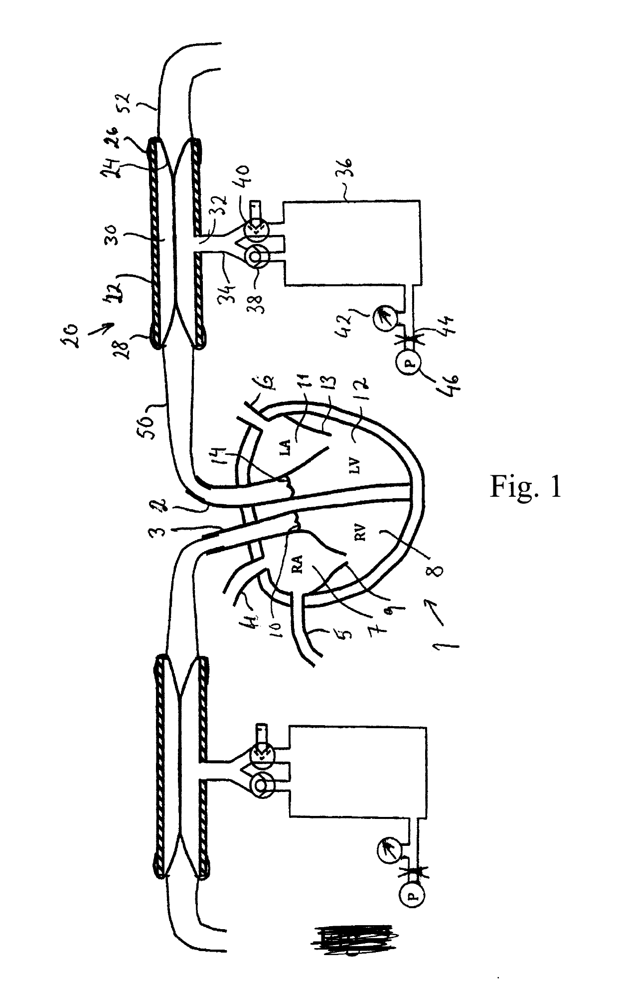 Afterload device for a beating heart during examination thereof