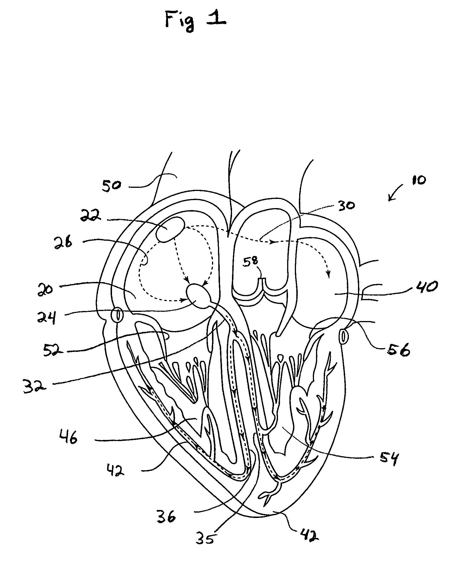 System and method of AV interval selection in an implantable medical device