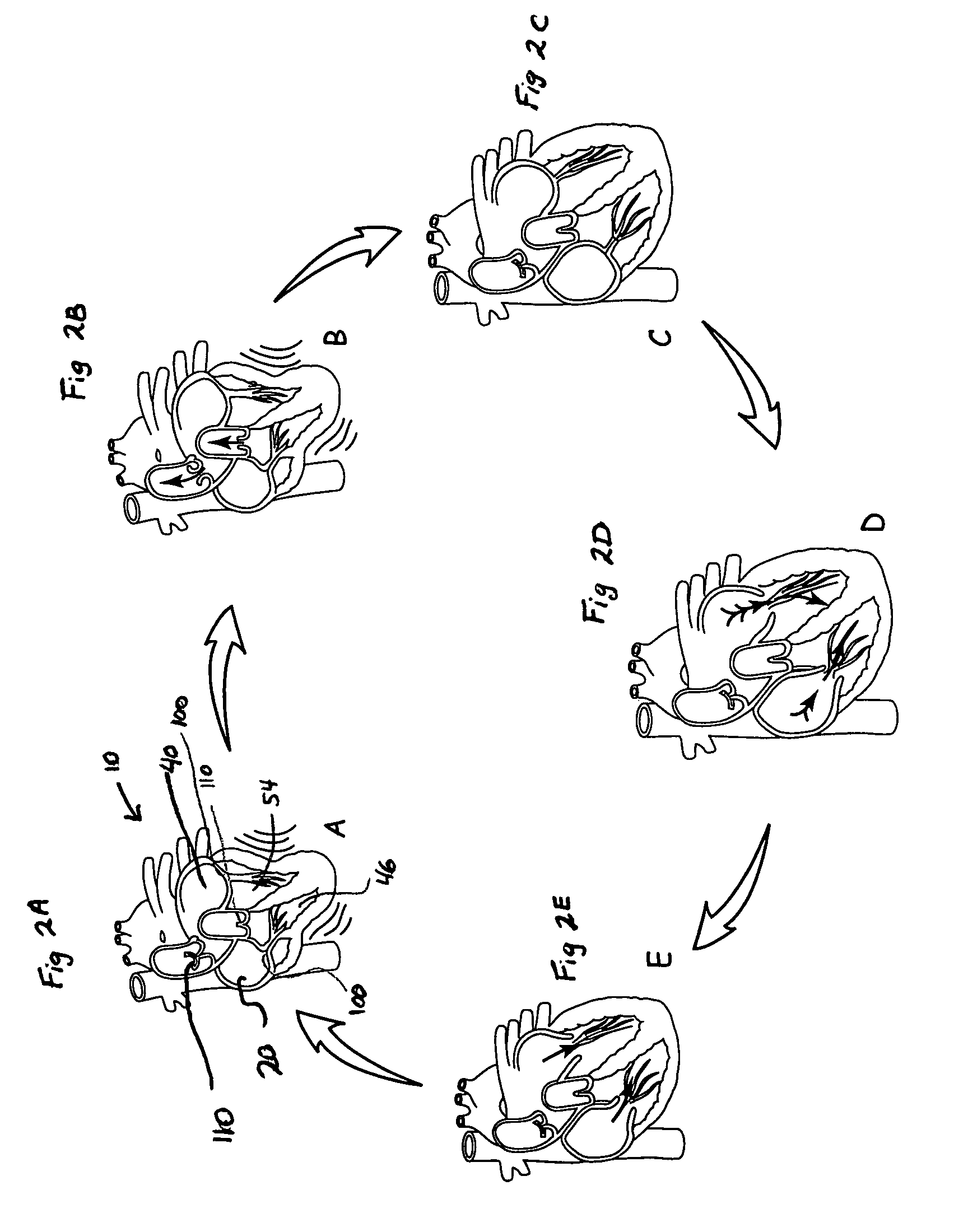 System and method of AV interval selection in an implantable medical device