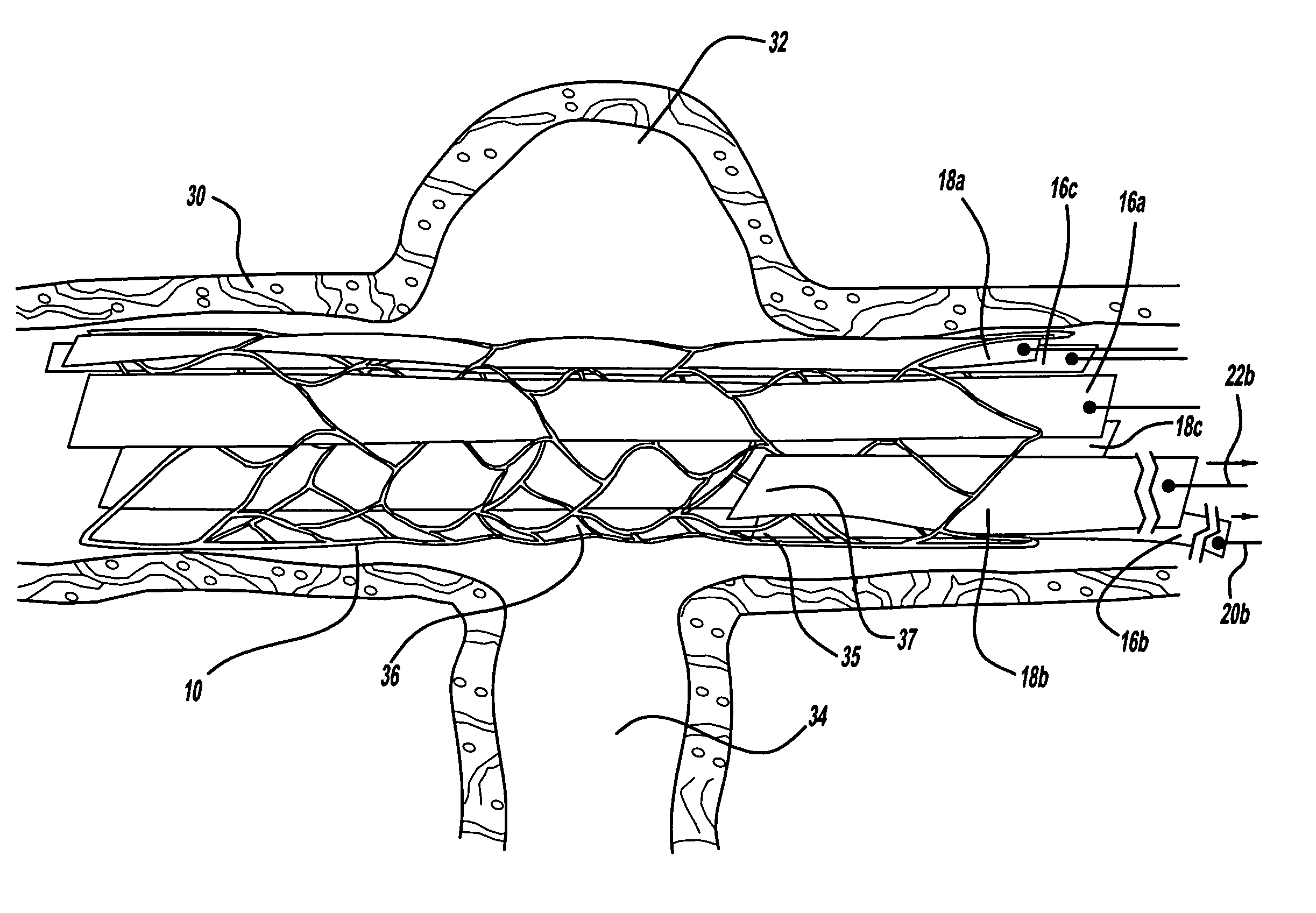 Expandable stent having removable slat members