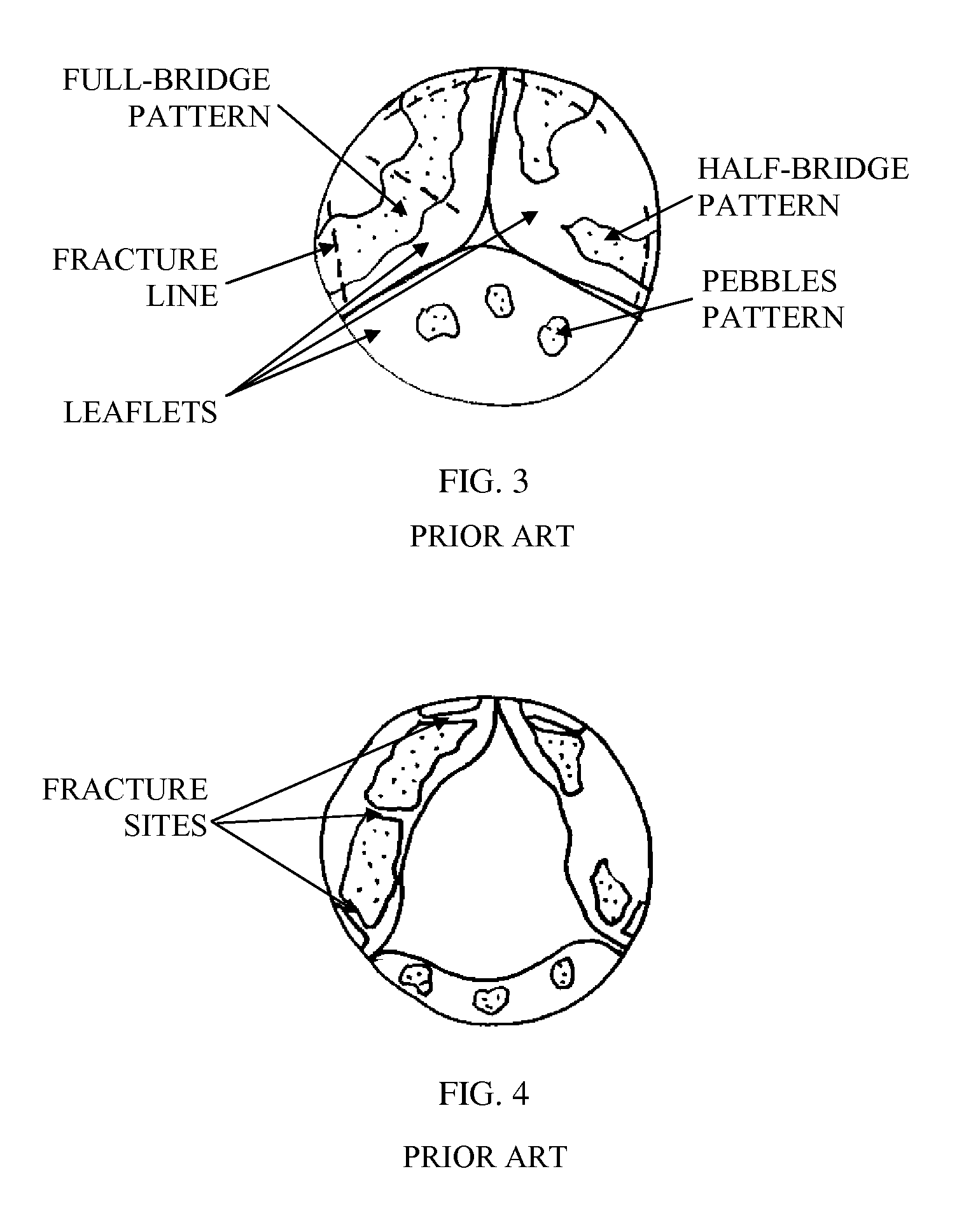 Fracturing calcifications in heart valves