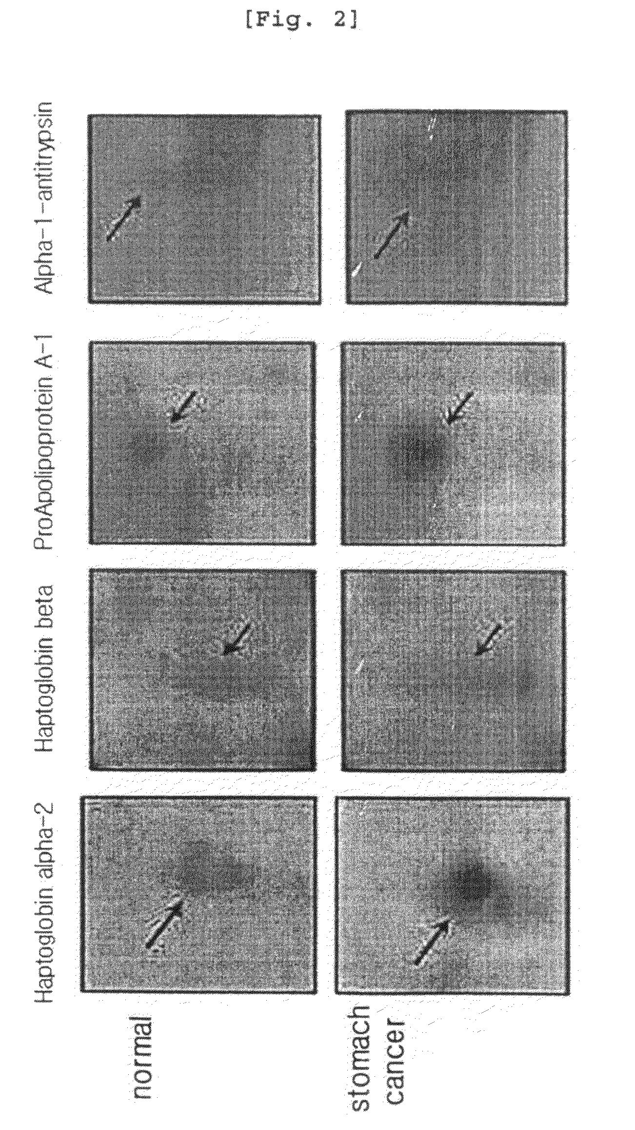 Protein markers for diagnosing stomach cancer and the diagnostic kit using them