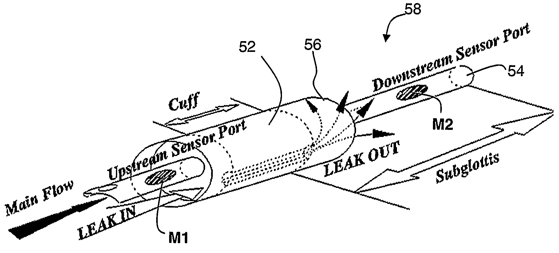 Ajustment of endotracheal tube cuff filling