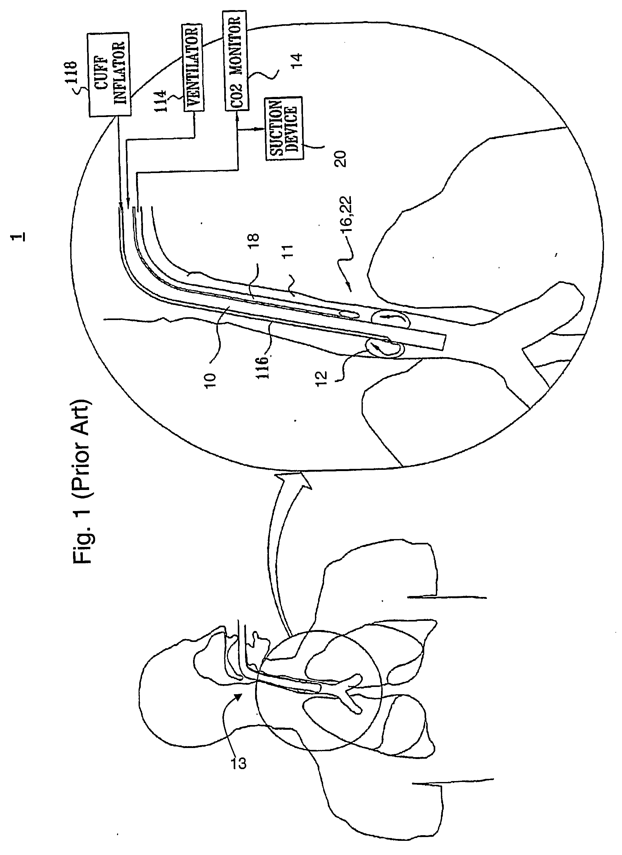 Ajustment of endotracheal tube cuff filling