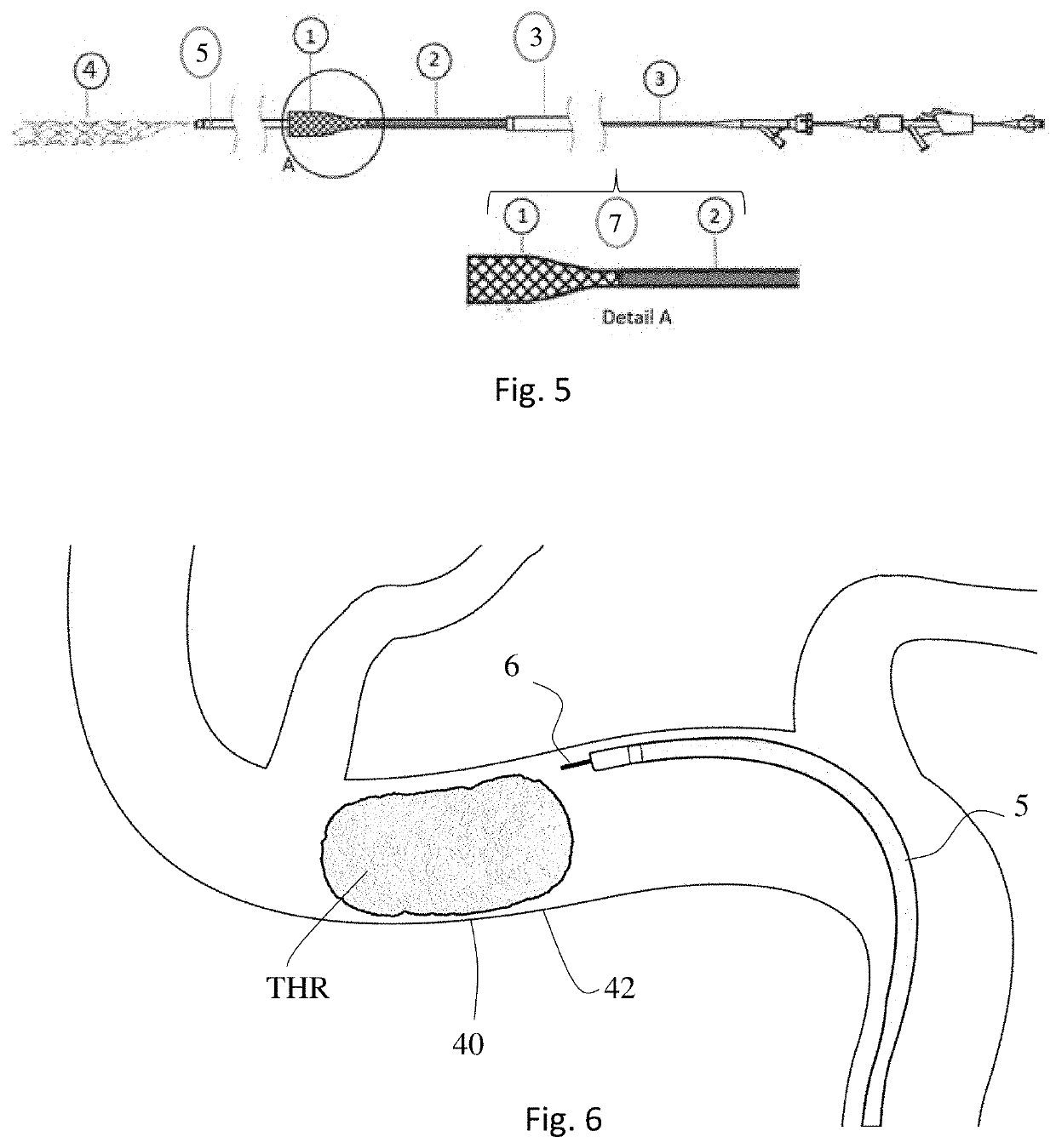 Thrombectomy system and method of use