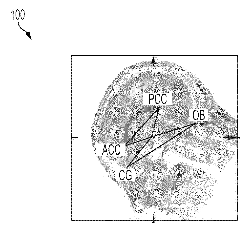 Method and System for Anatomic Landmark Detection Using Constrained Marginal Space Learning and Geometric Inference