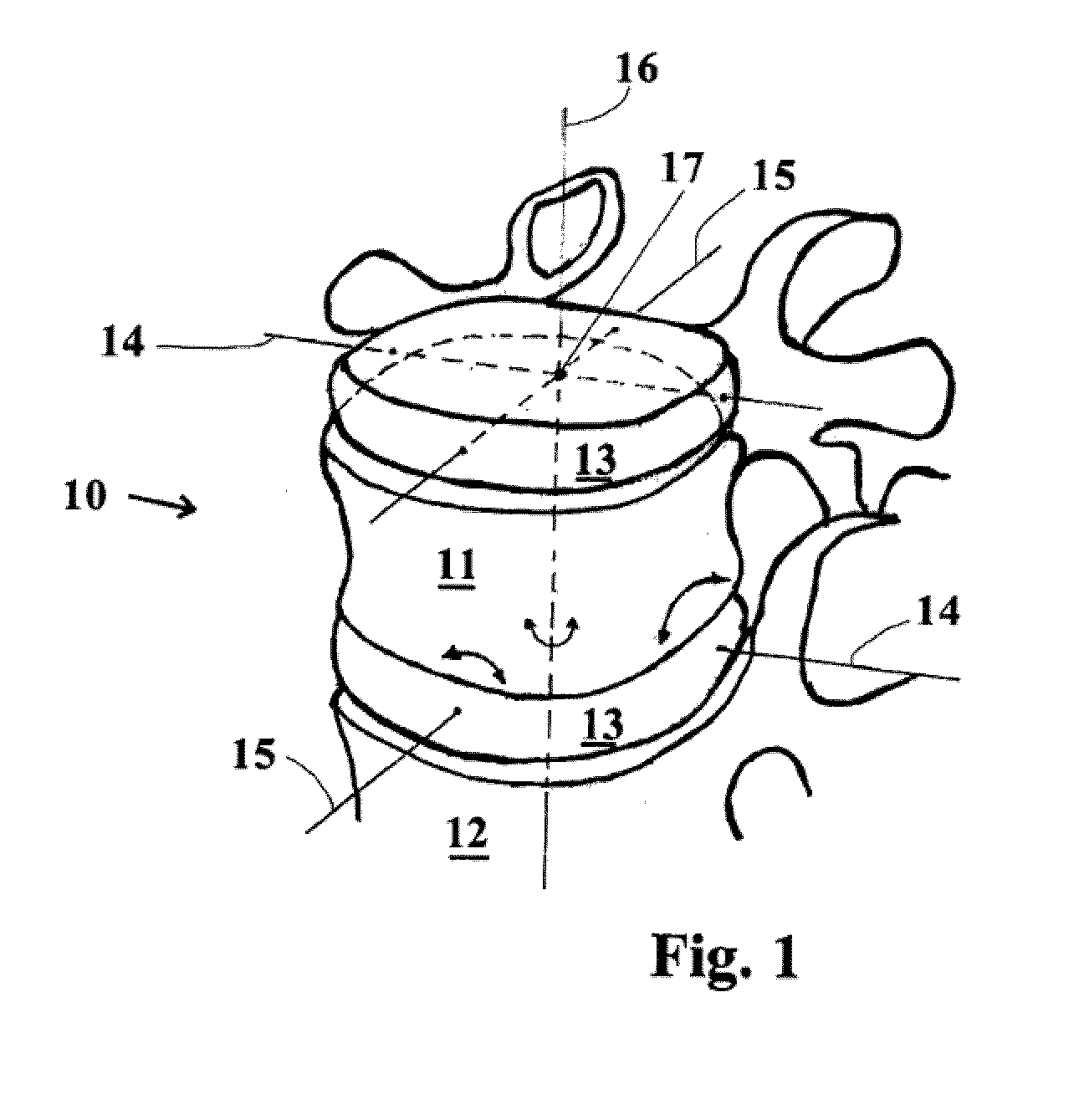 Movable Intervertebral Disc Prosthesis