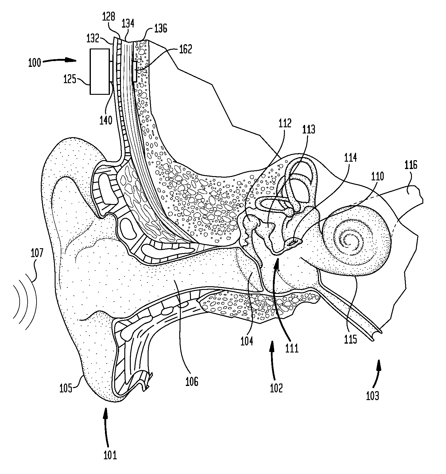 Transcutaneous magnetic bone conduction device