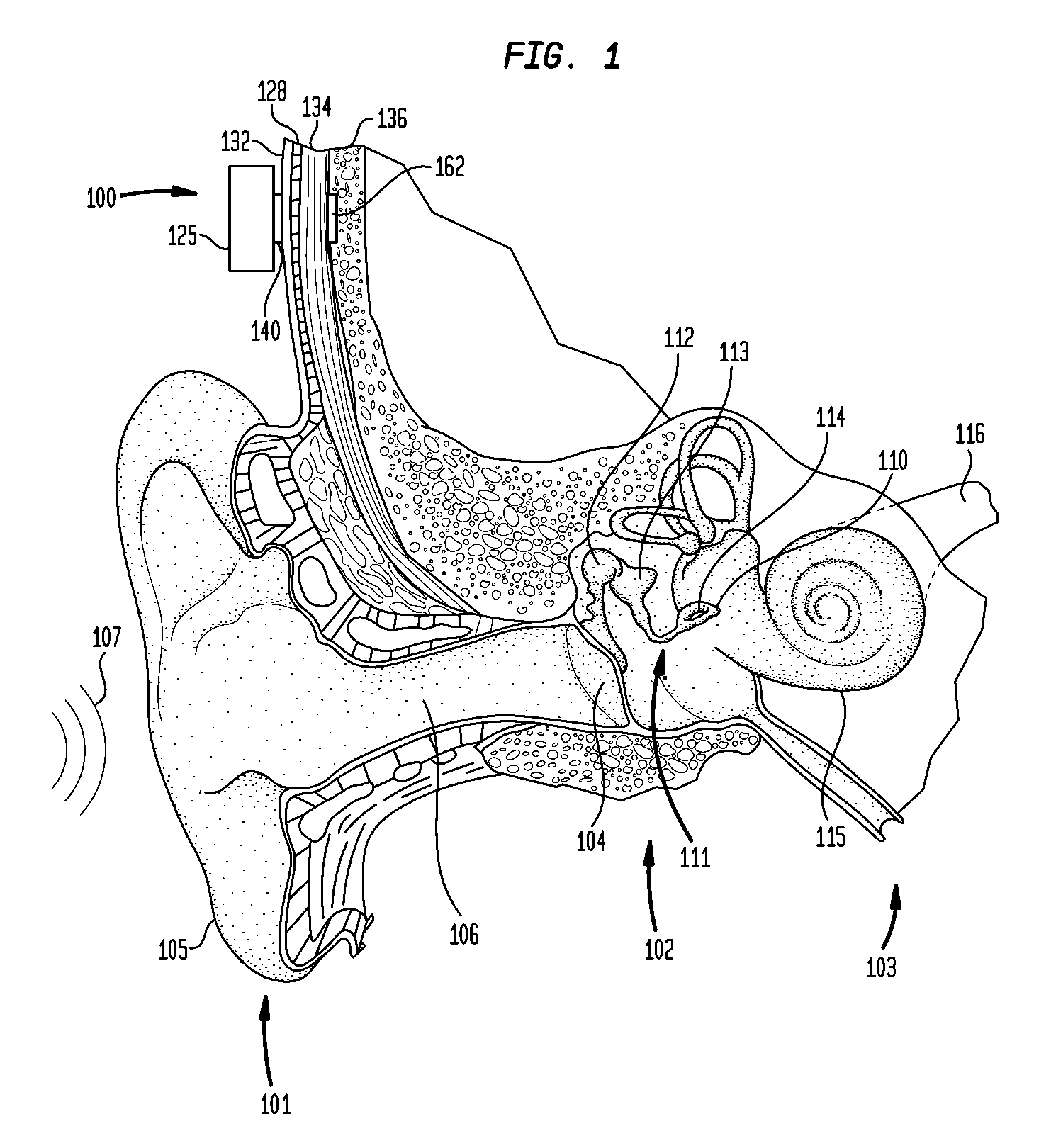 Transcutaneous magnetic bone conduction device