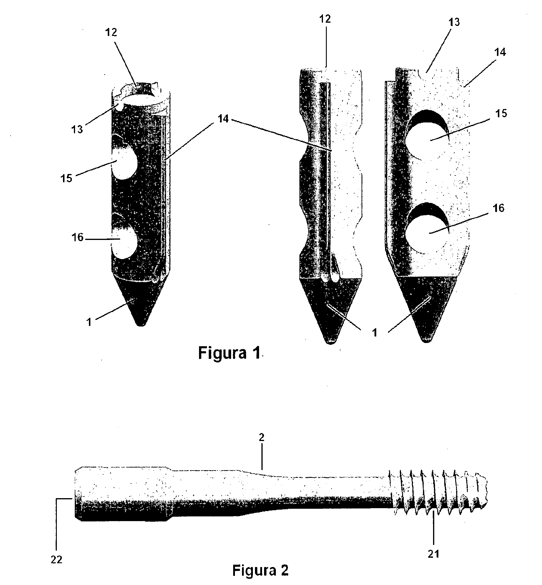 Locking nail system for arthrodesis reconstruction in calcaneus fractures