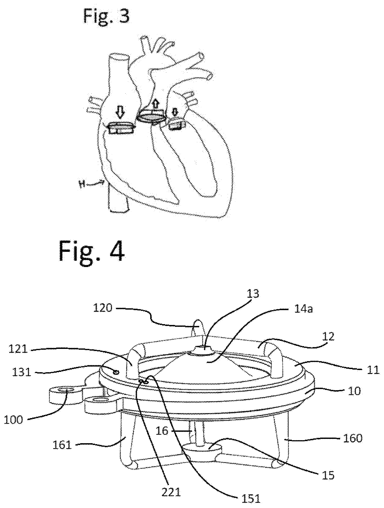 Single circular convex magnet leaflet disc with an opposing upper and lower magnetic field and electronic semiconductor sensor prosthetic heart valve that can communicate from the heart to the brain