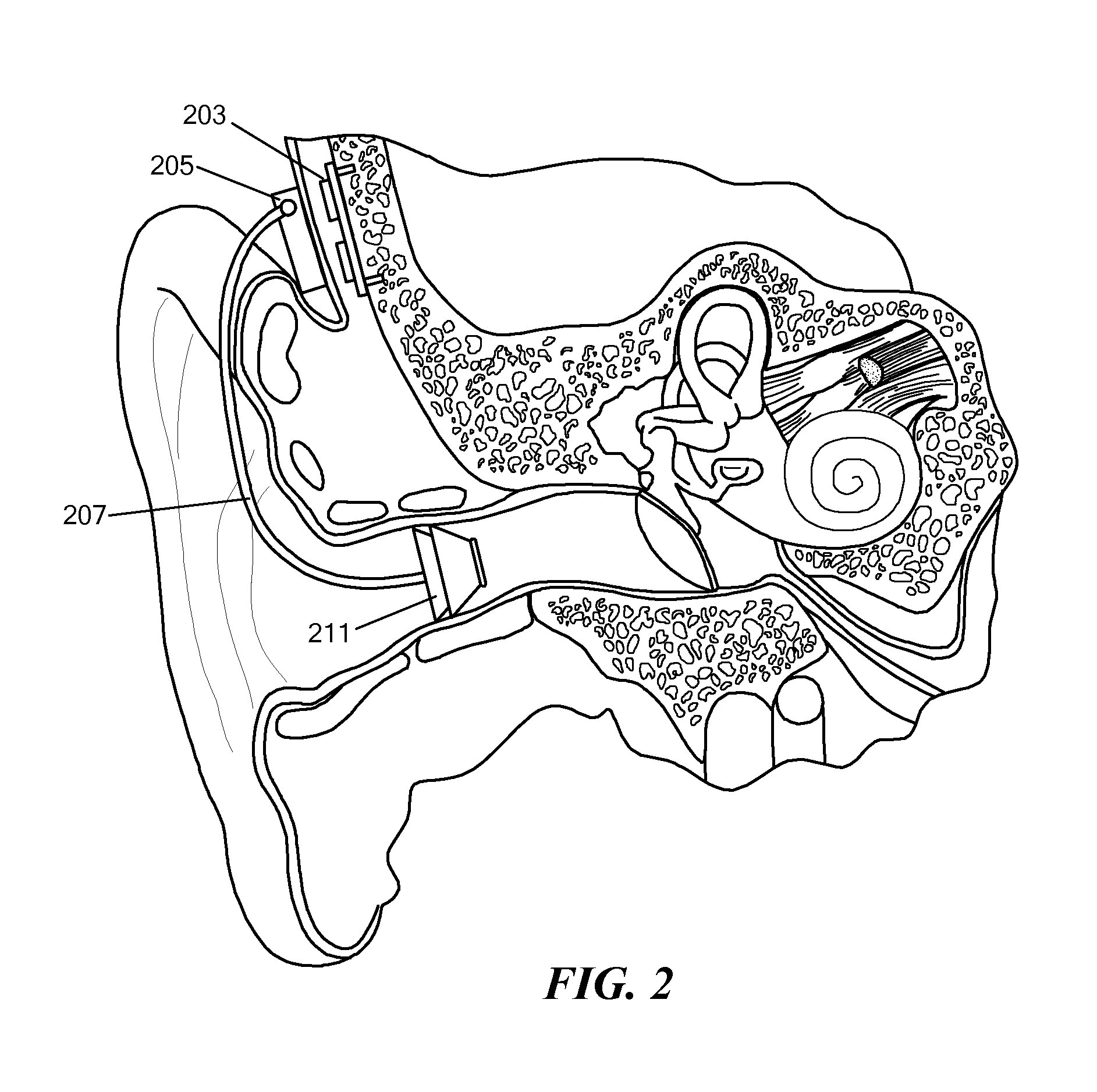 Hearing System