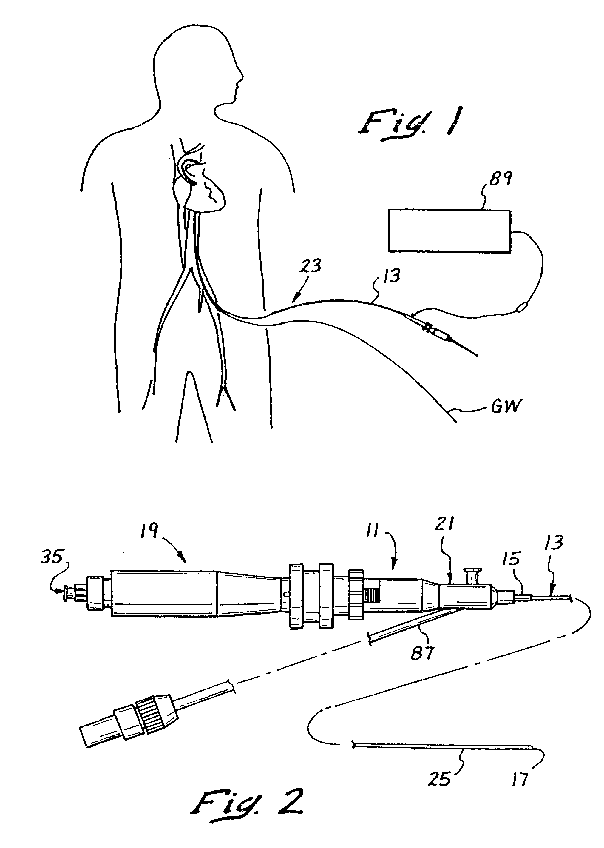 Methods for bypassing total or near-total obstructions in arteries or other anatomical conduits