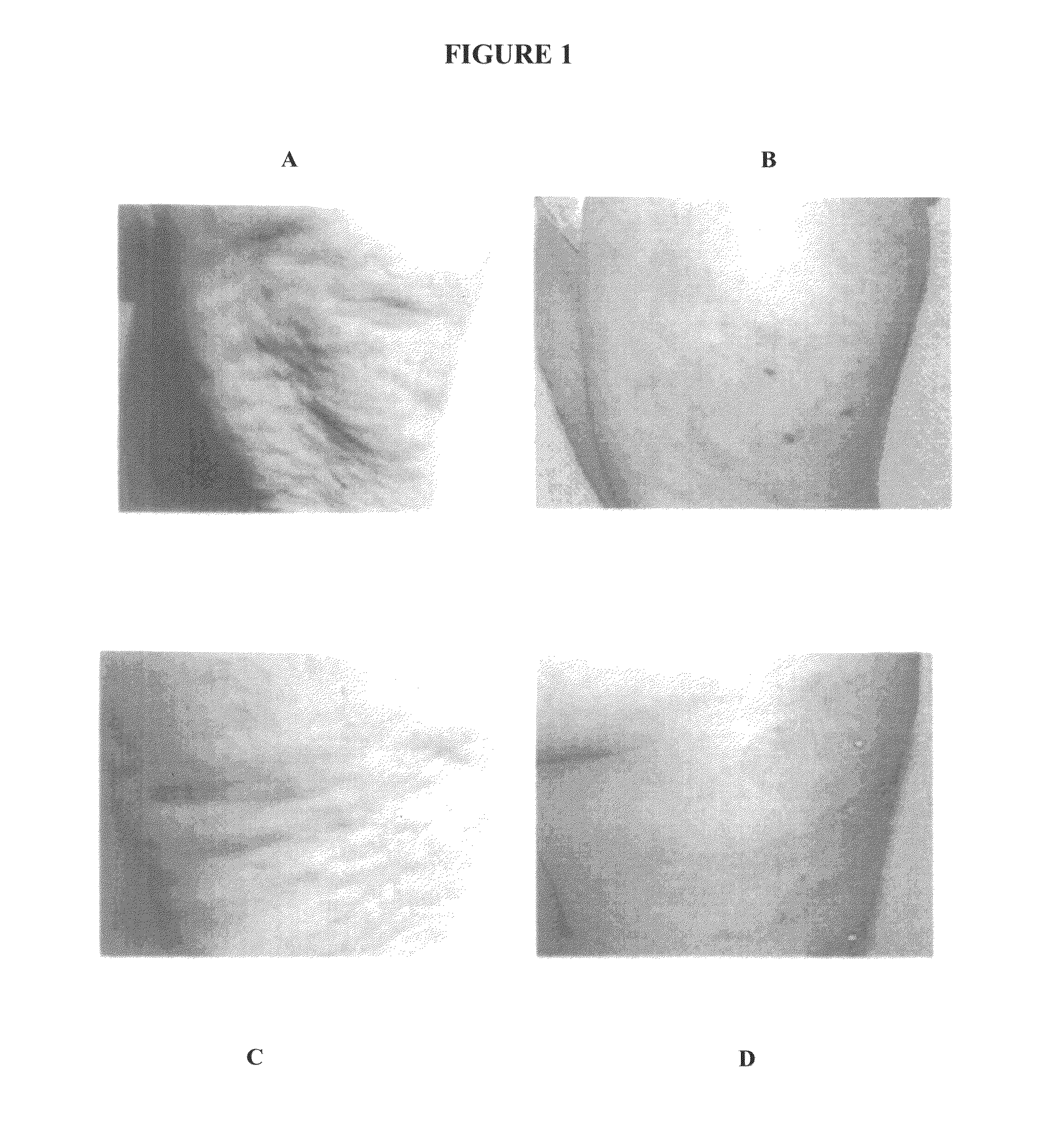 PDT treatment method for cellulites and cosmetic use