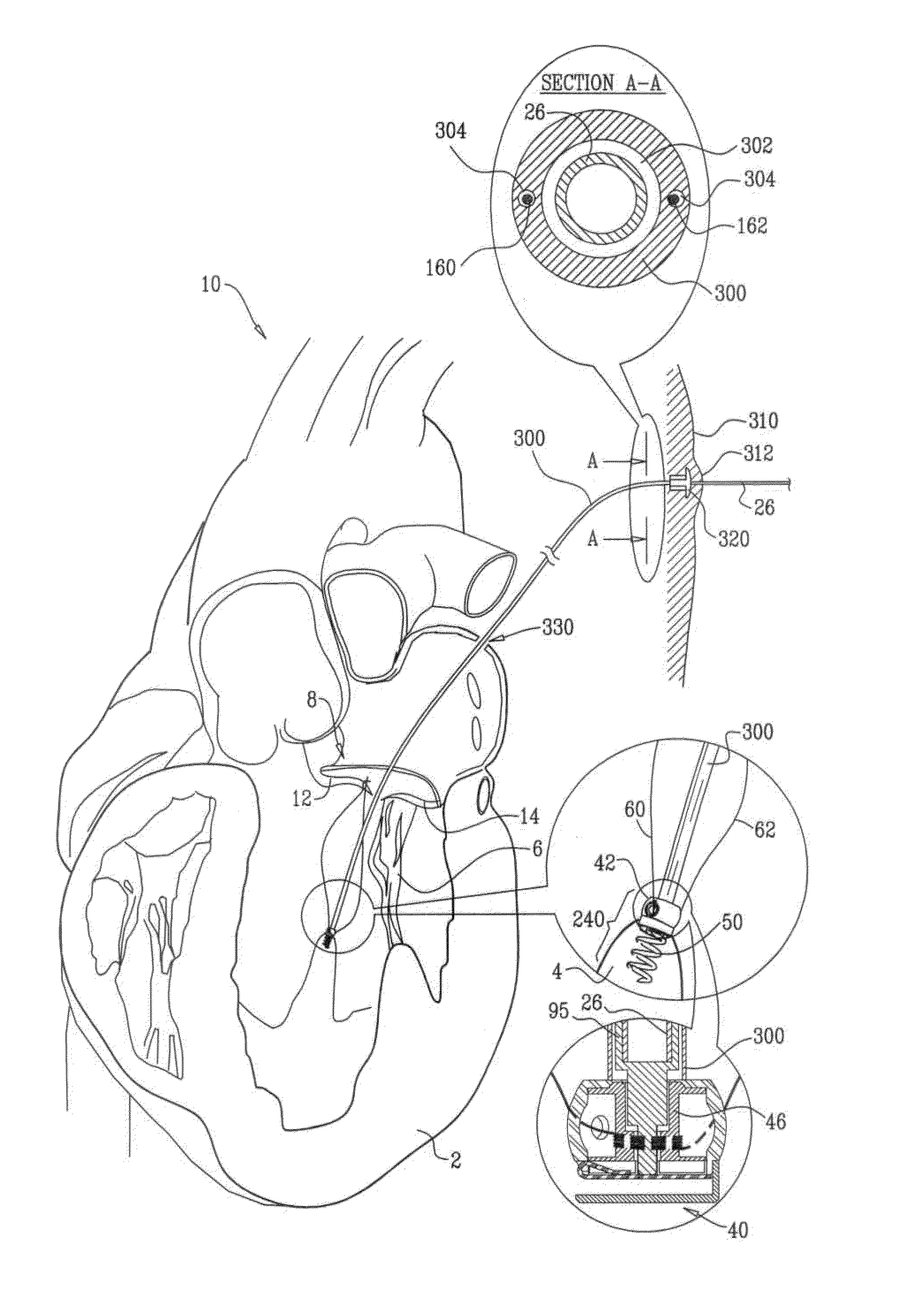 Implantation of repair chords in the heart