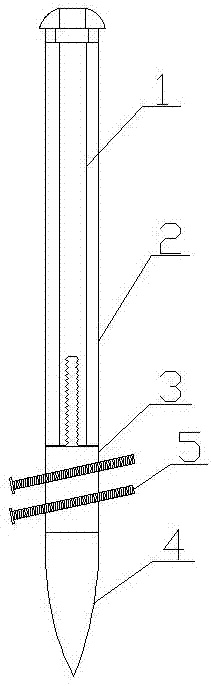 interlocking intramedullary nail