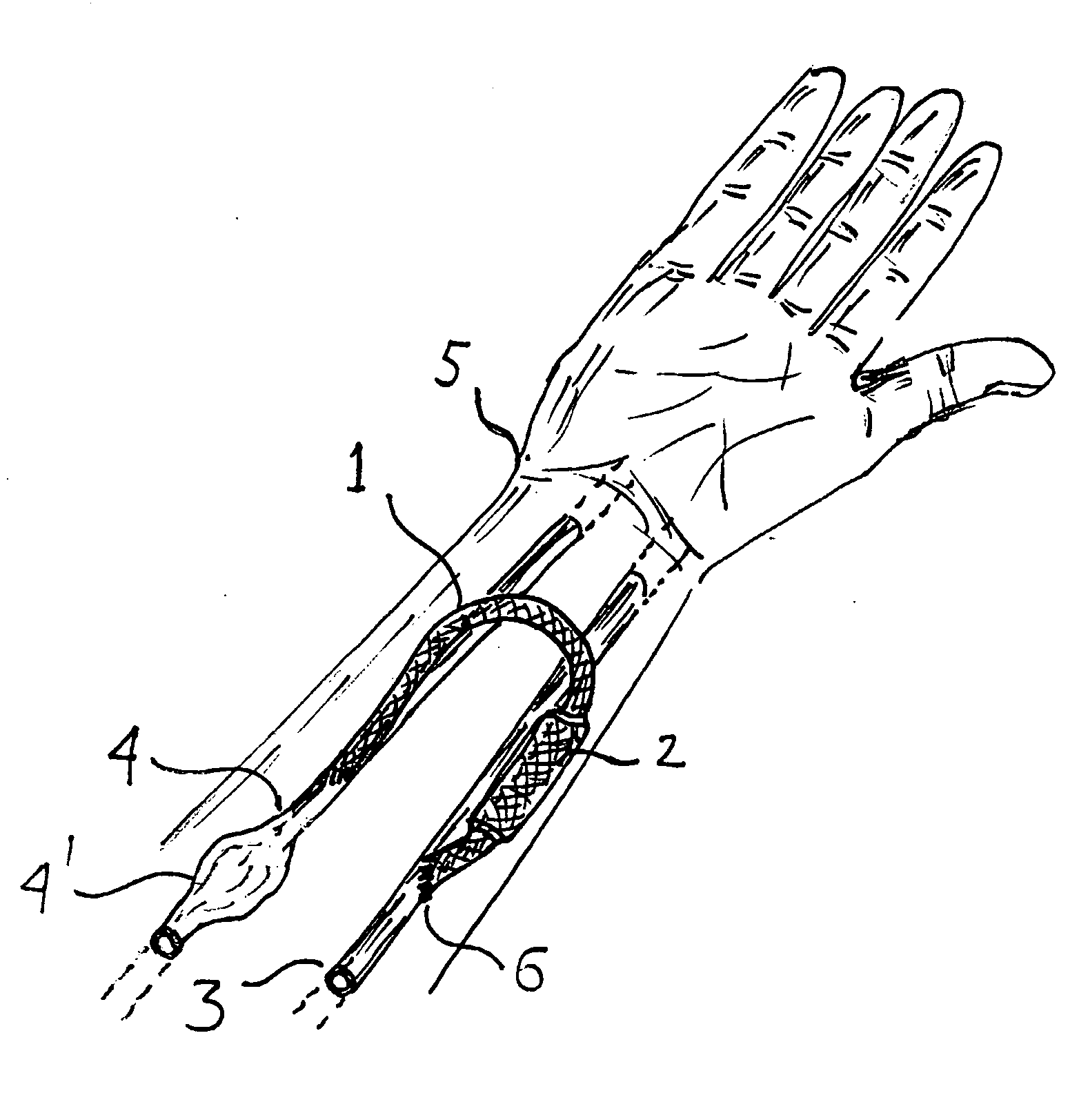 Externally adjustable blood flow valve