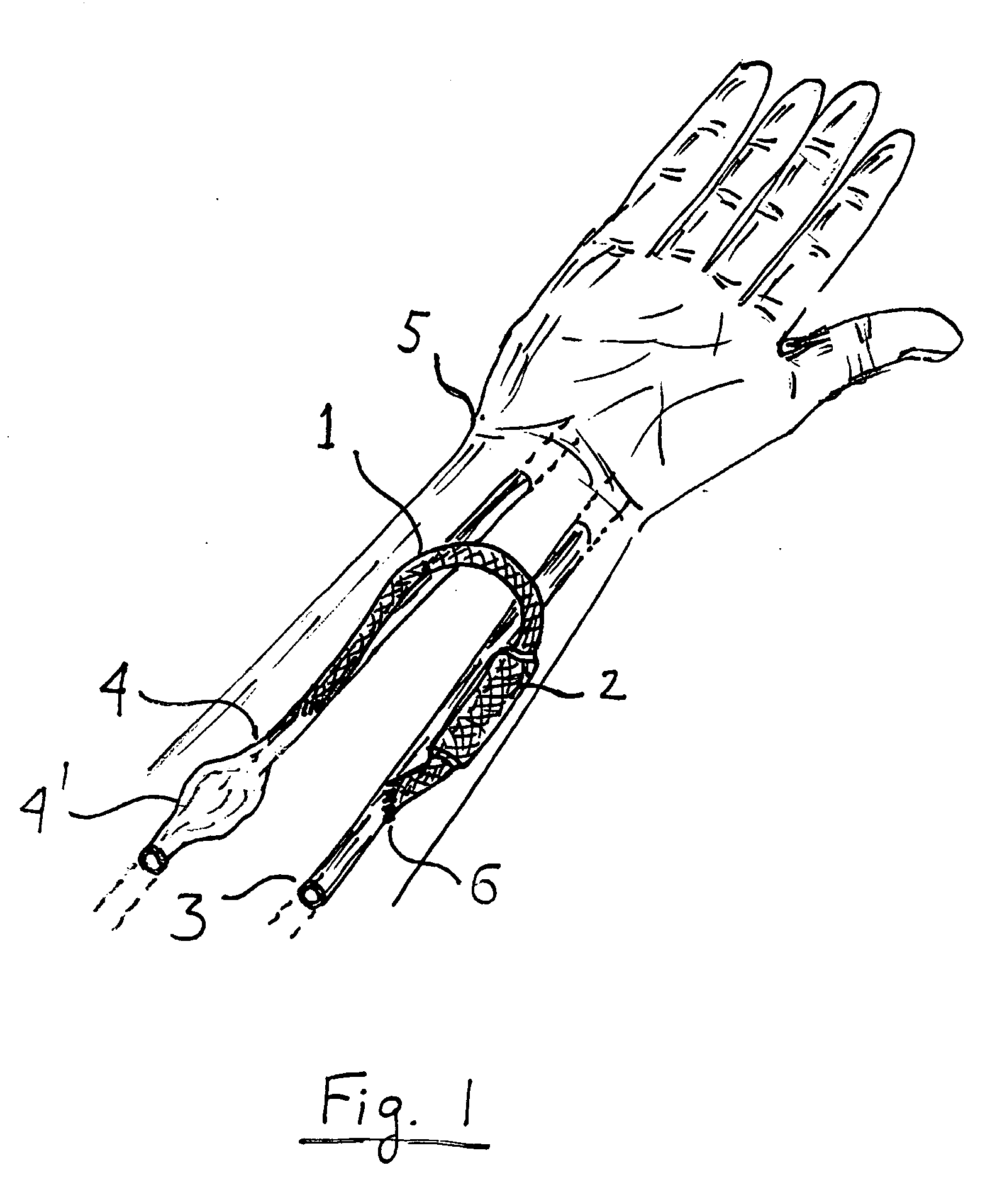 Externally adjustable blood flow valve