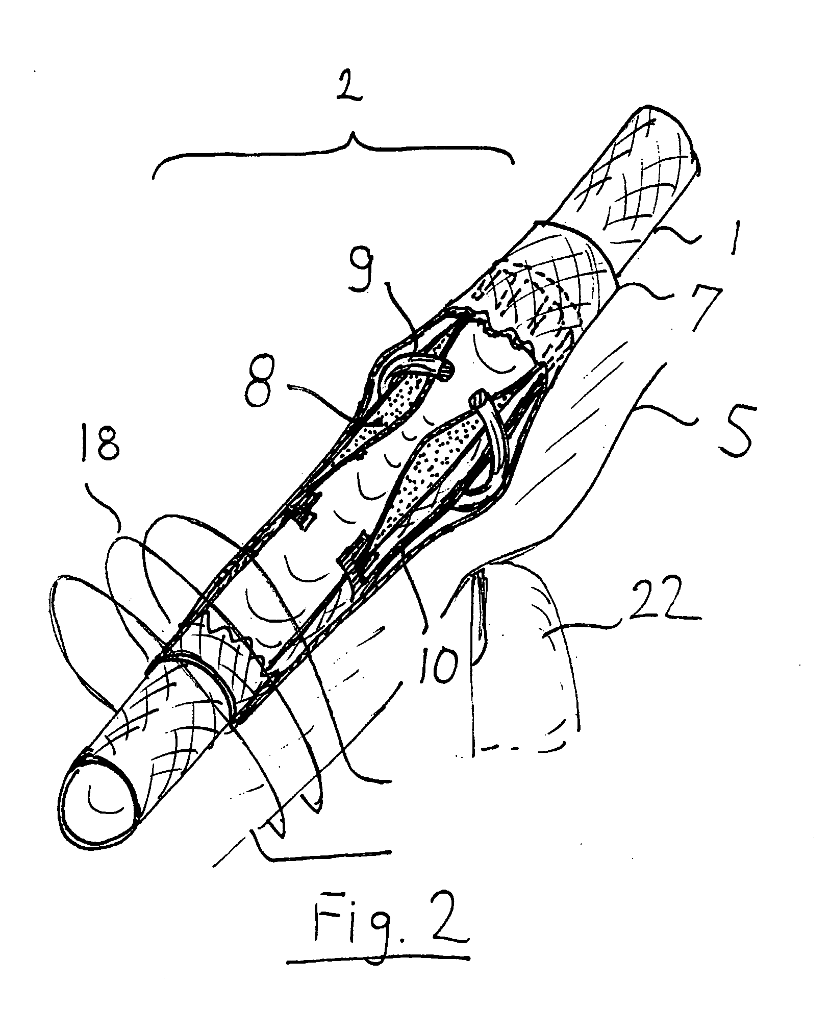 Externally adjustable blood flow valve