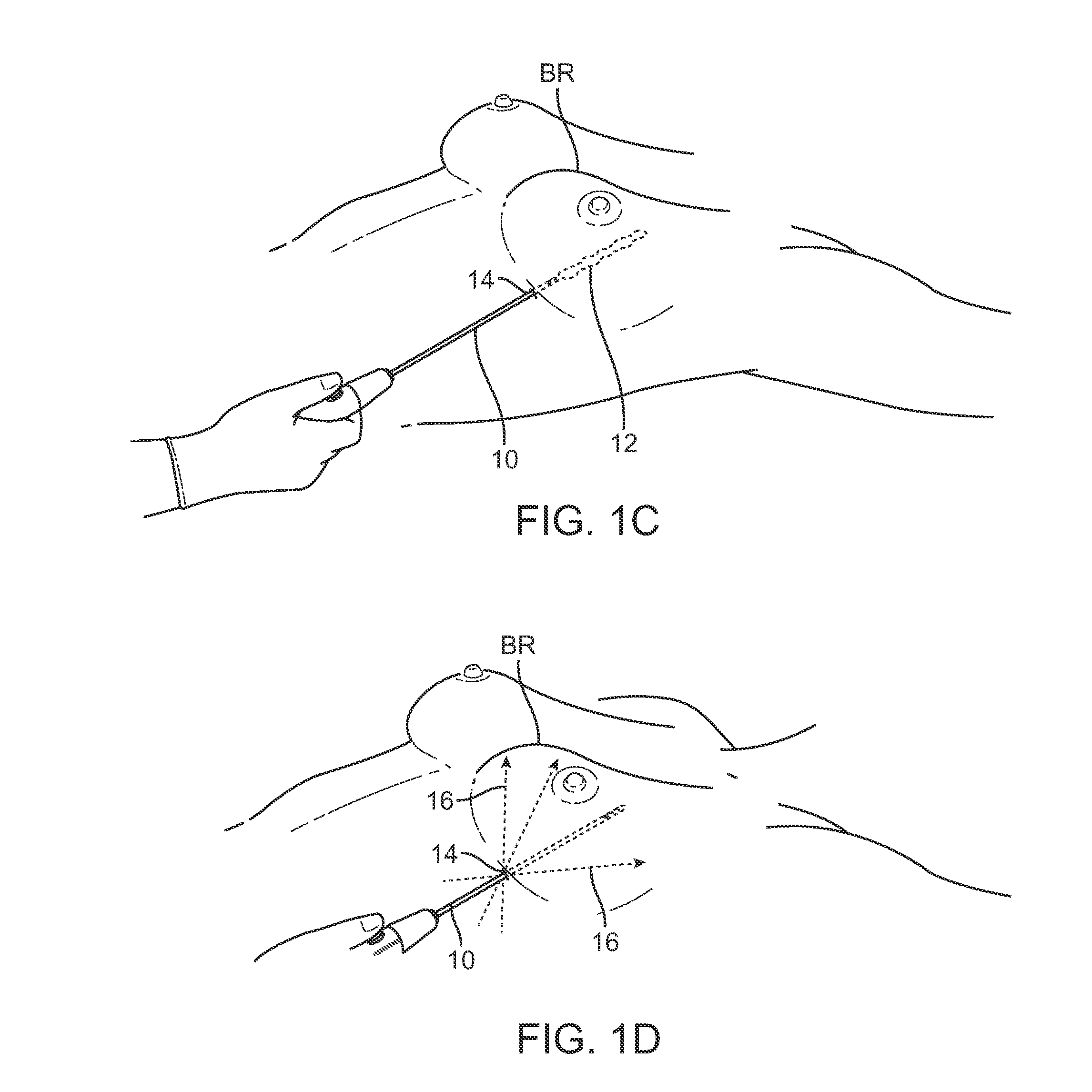 Devices and methods for tissue transfer