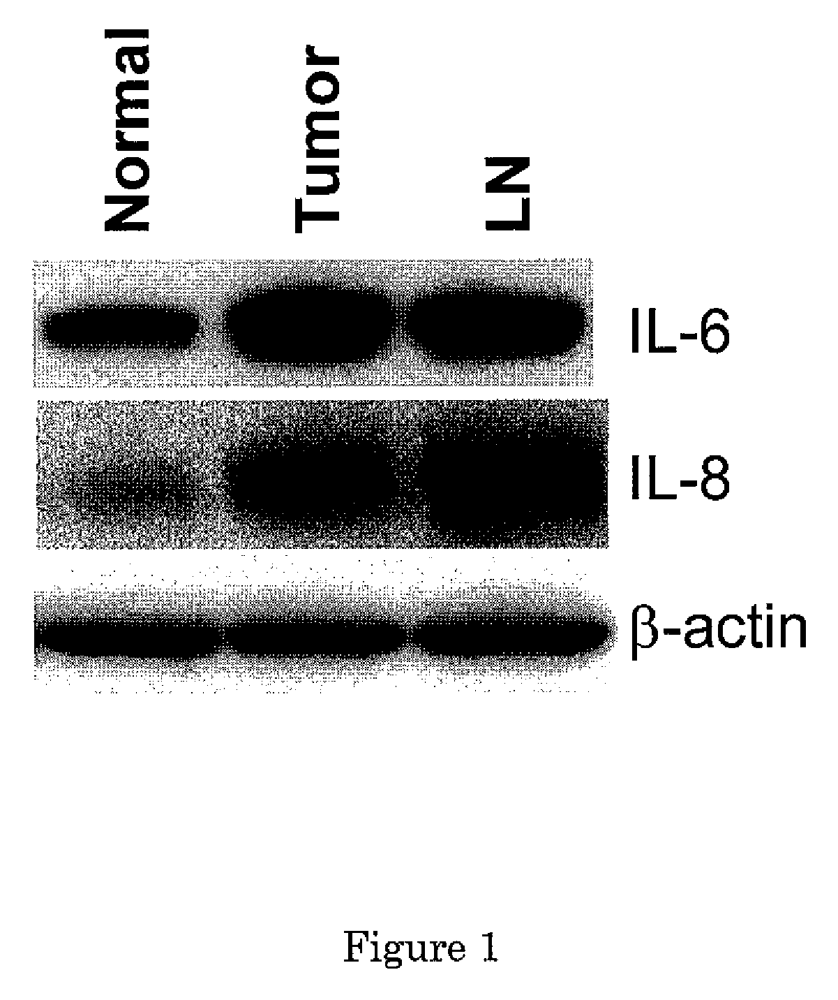 Development of prognostic markers from the saliva of head and neck cancer patients