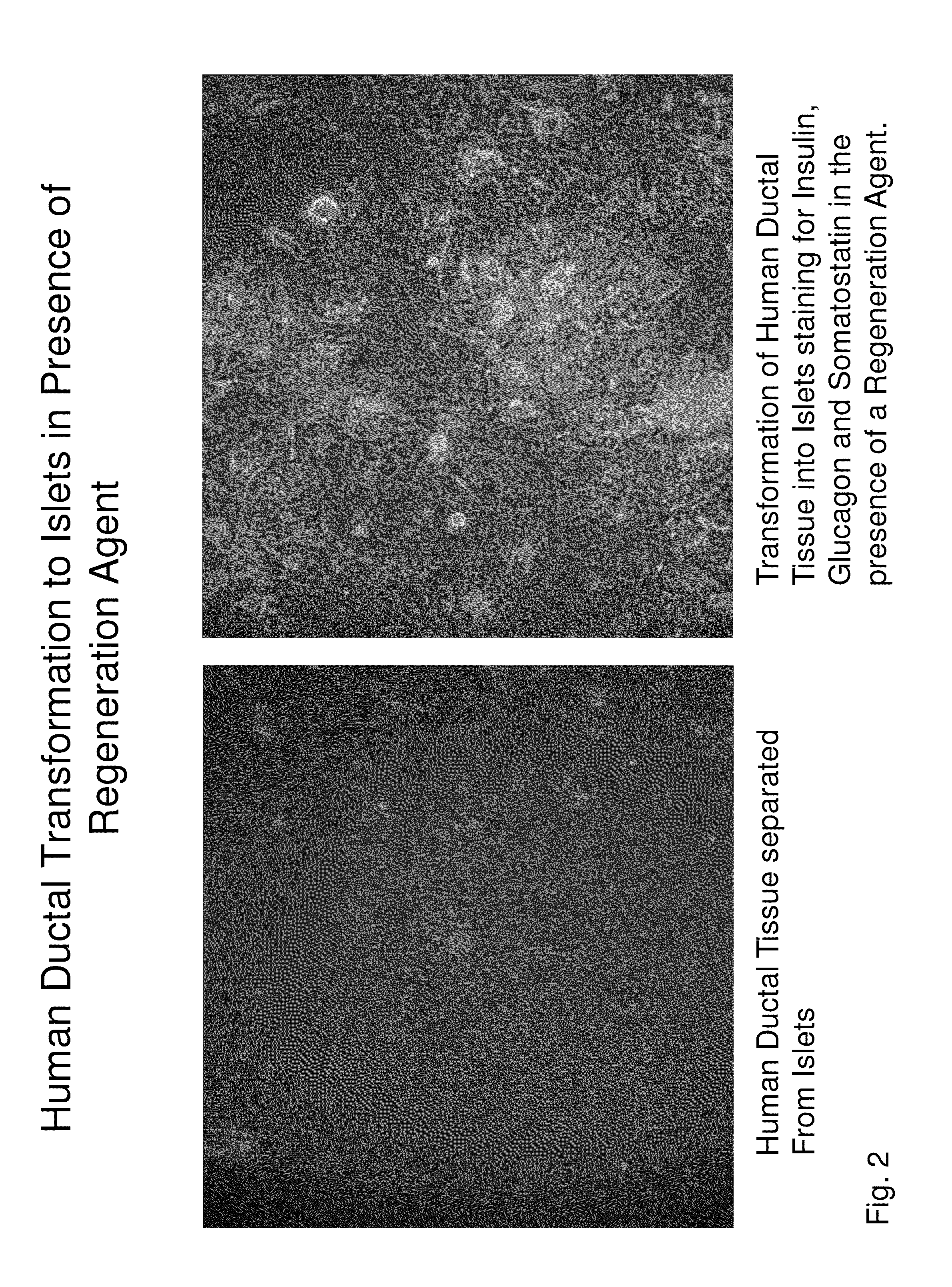 Insulin independence among patients with diabetes utilizing a PPI in combination with an immune tolerance agent