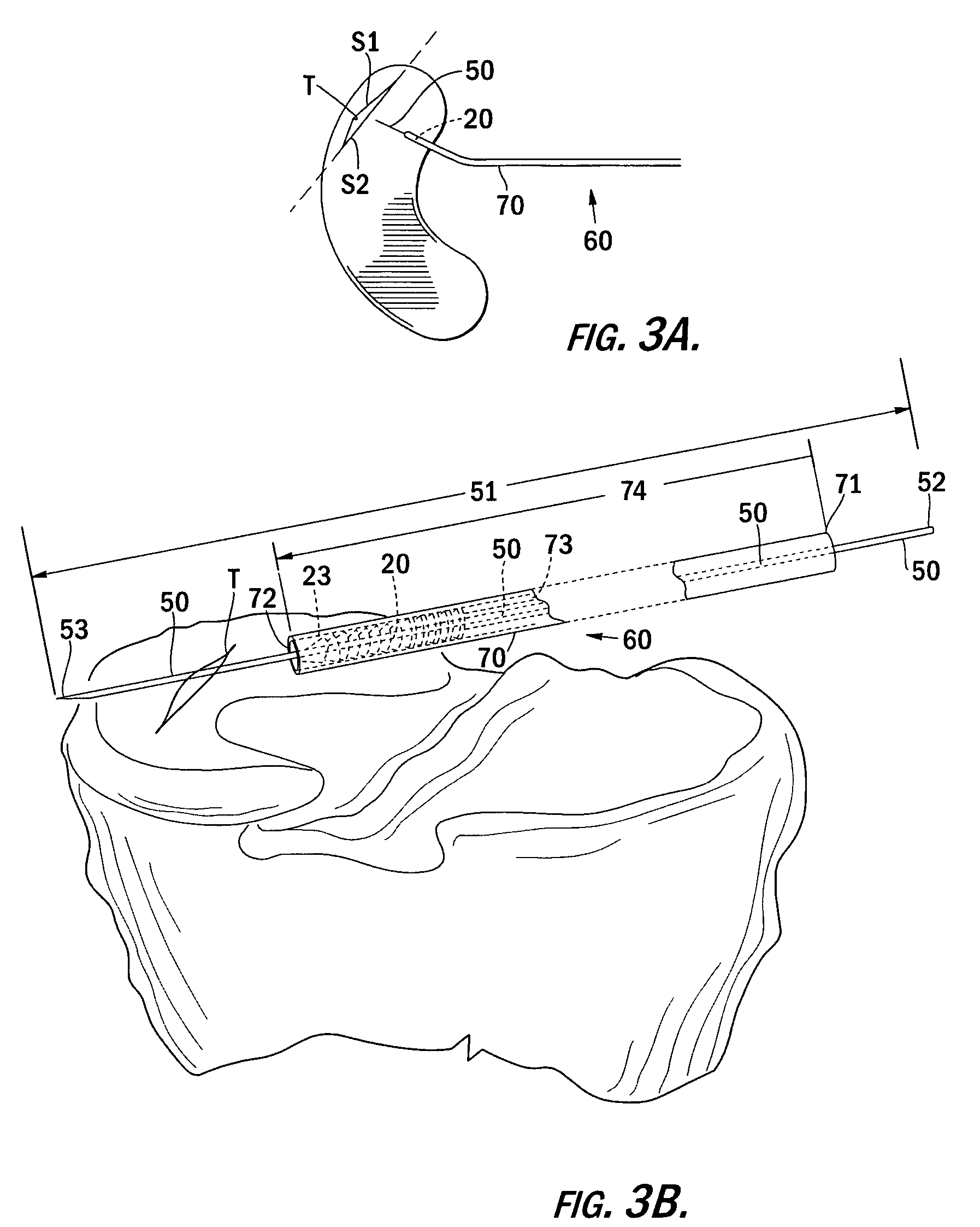 Orthopedic screw and method