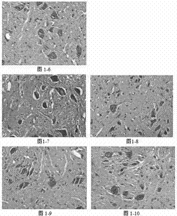 Application of hydrogen physiological saline in preparation for medicine treating acute neurological damage diseases