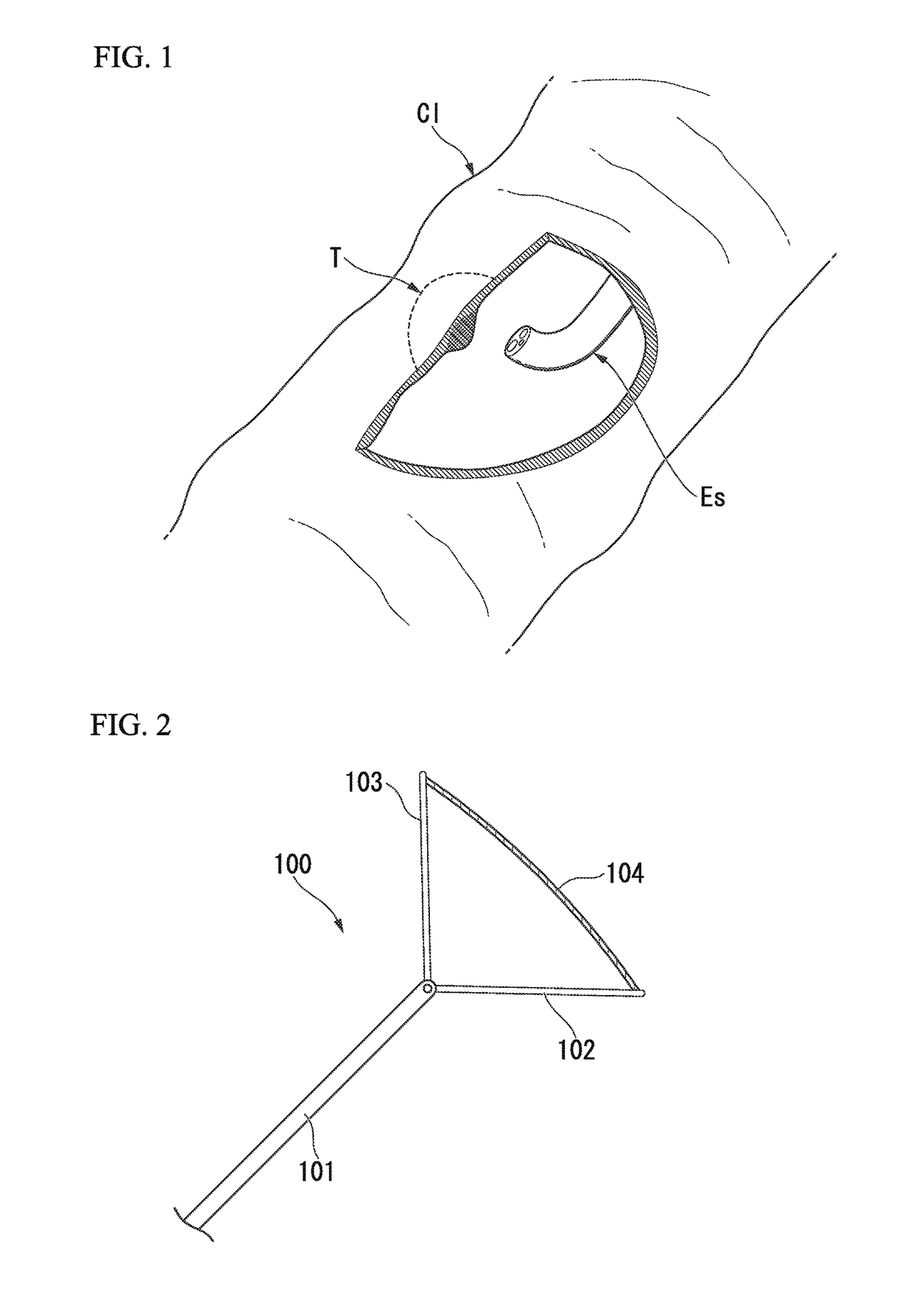 Tissue removal system