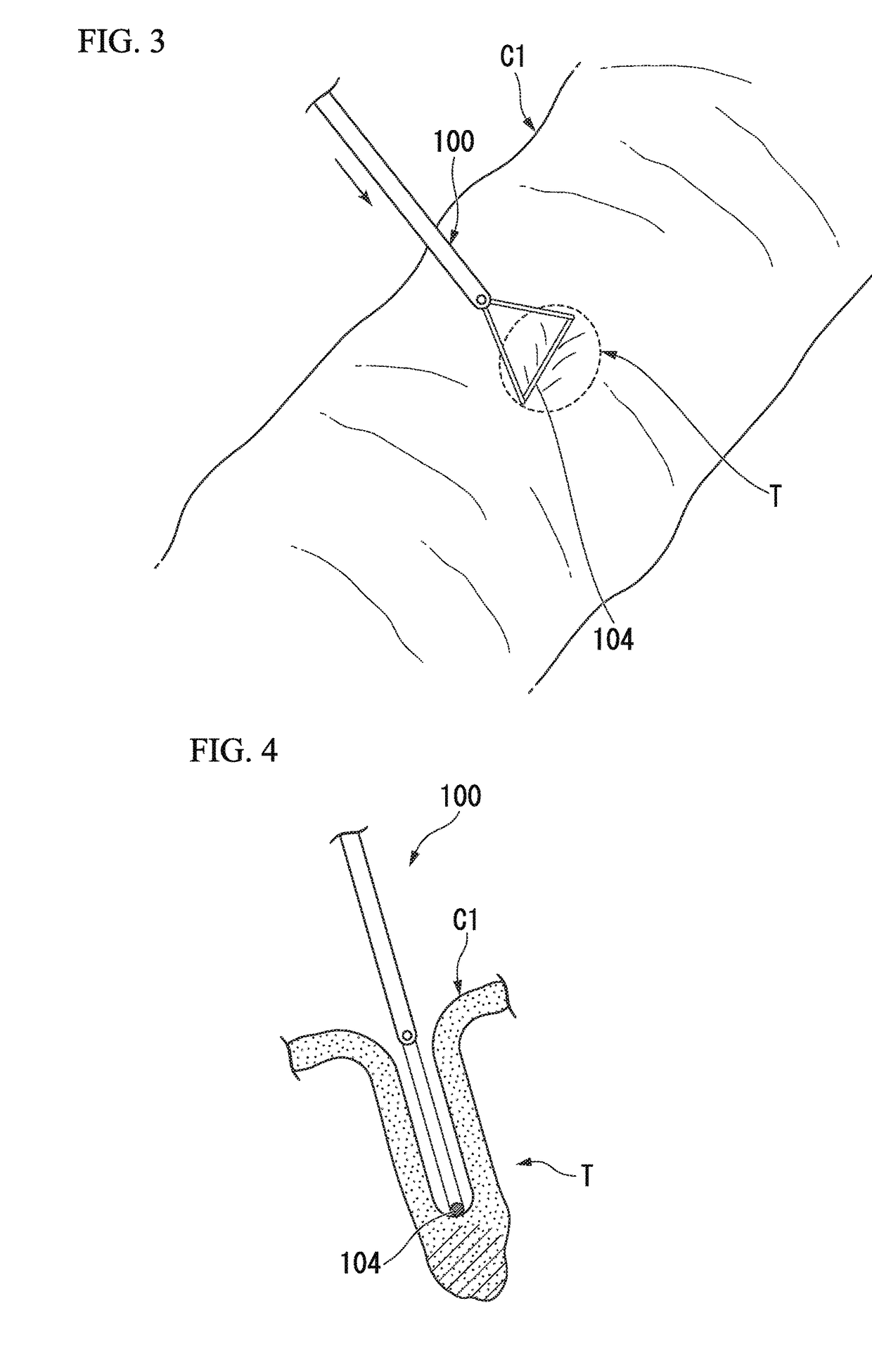 Tissue removal system