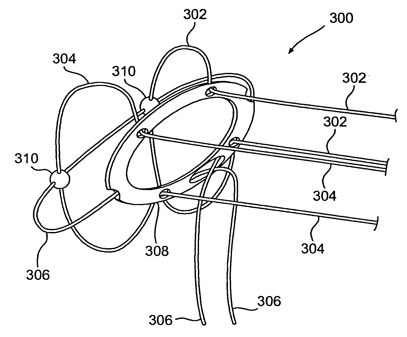 Spinal disc annulus reconstruction method and deformable spinal disc annulus stent