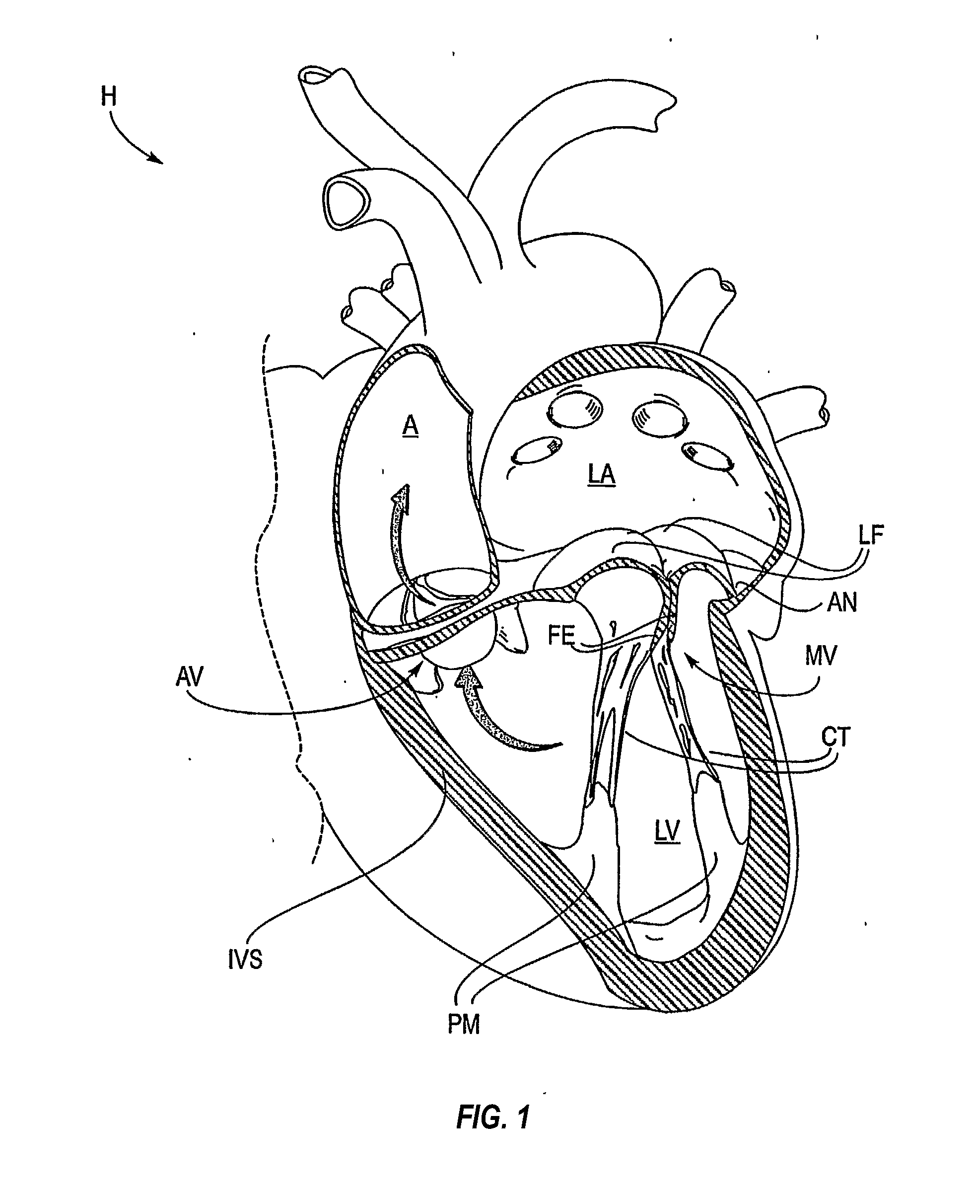 Mitral valve fixation device removal devices and methods