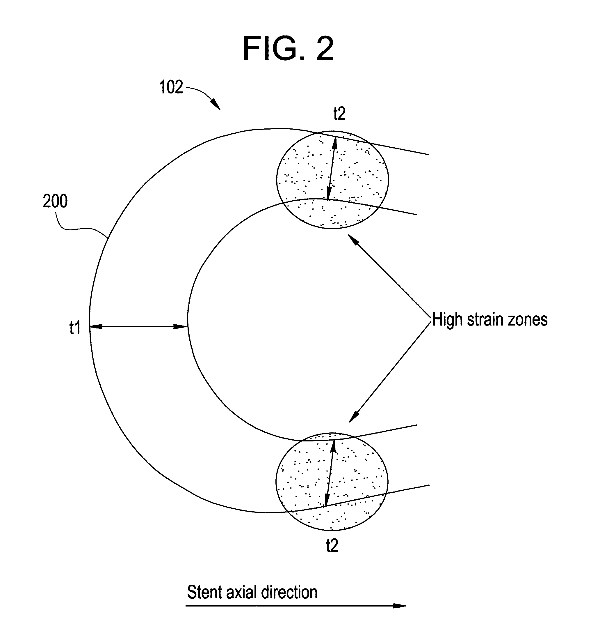 Balloon expandable bioabsorbable drug eluting stent