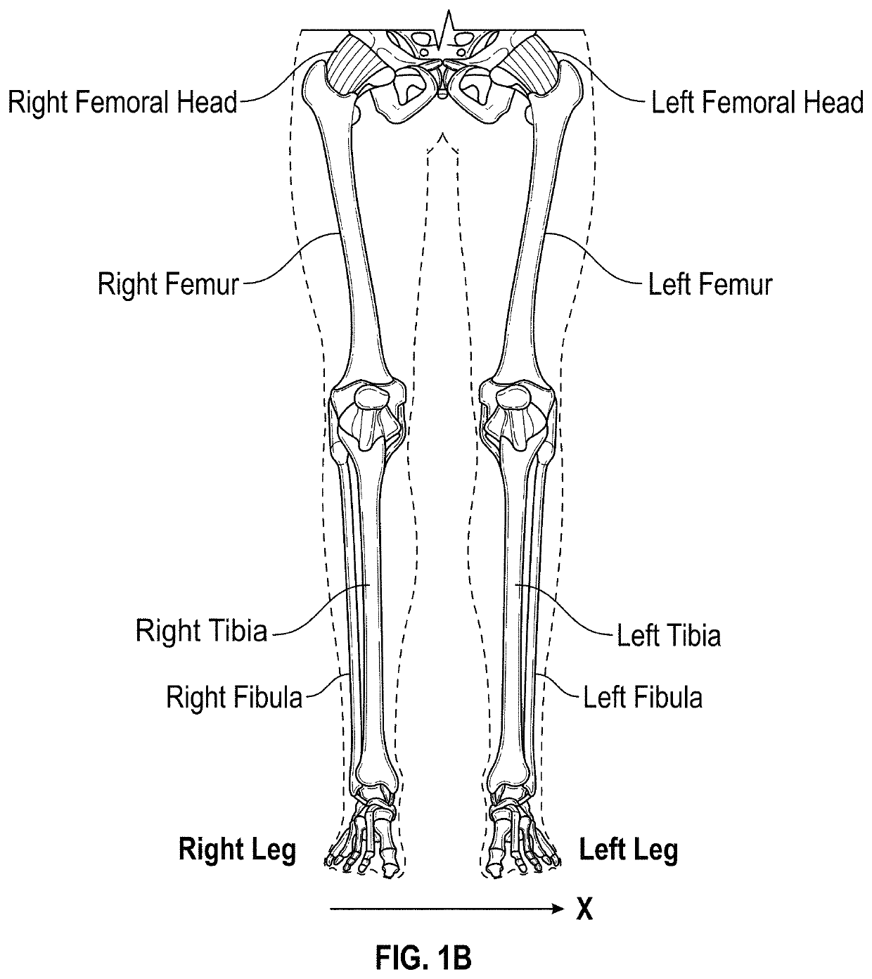 Knee replacement surgical cut planes estimation for restoring pre-arthritic alignment