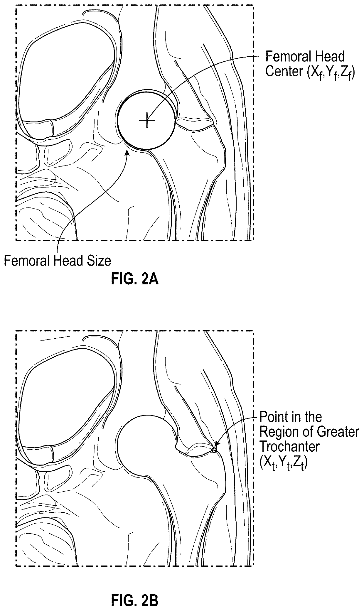 Knee replacement surgical cut planes estimation for restoring pre-arthritic alignment